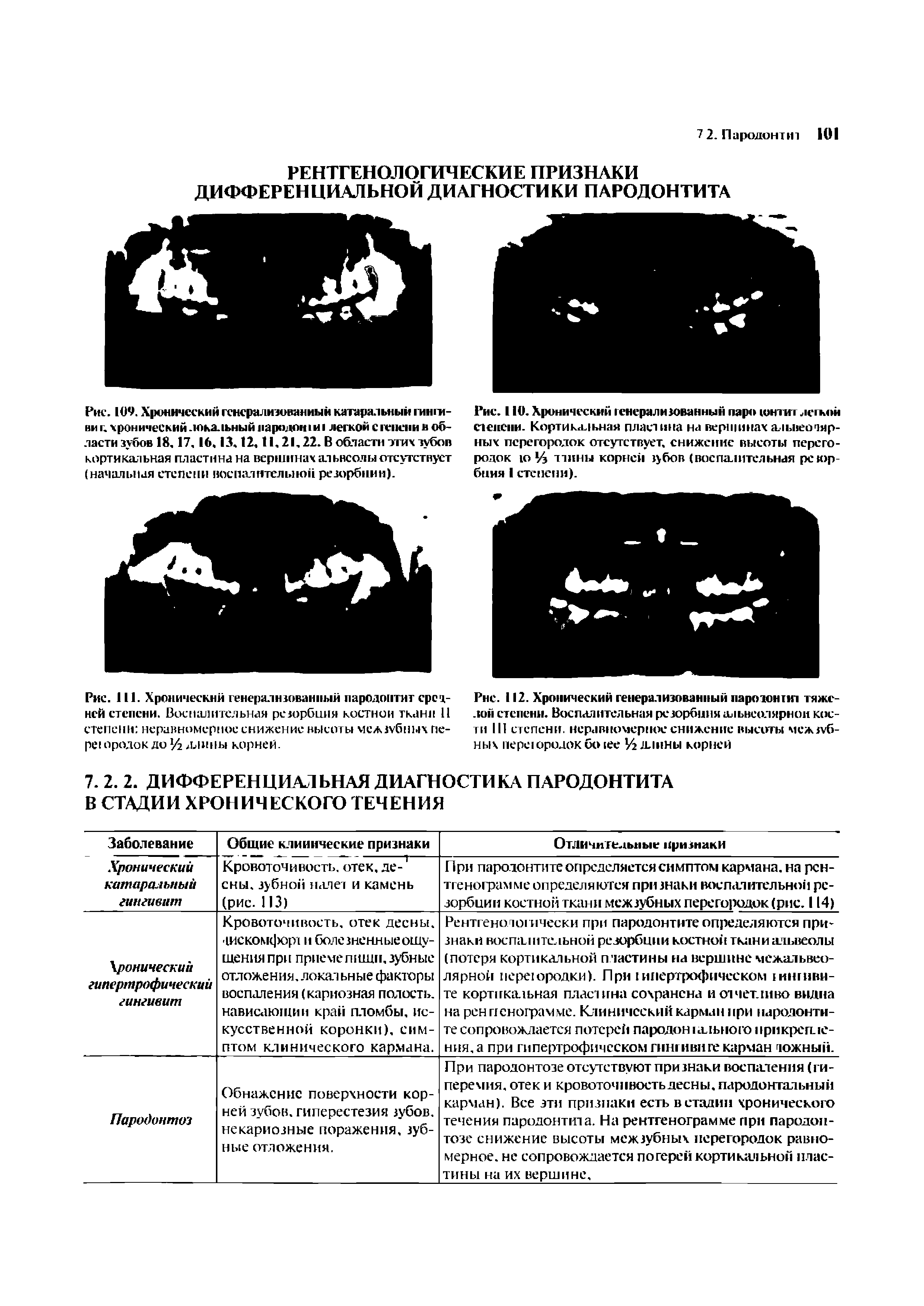 Рис. 111. Хронический генерализованный пародонтит средней степени. Воспалительная резорбция костной ткани 11 степени неравномерное снижение высоты межзубных пере ородок до 16 длины корней.