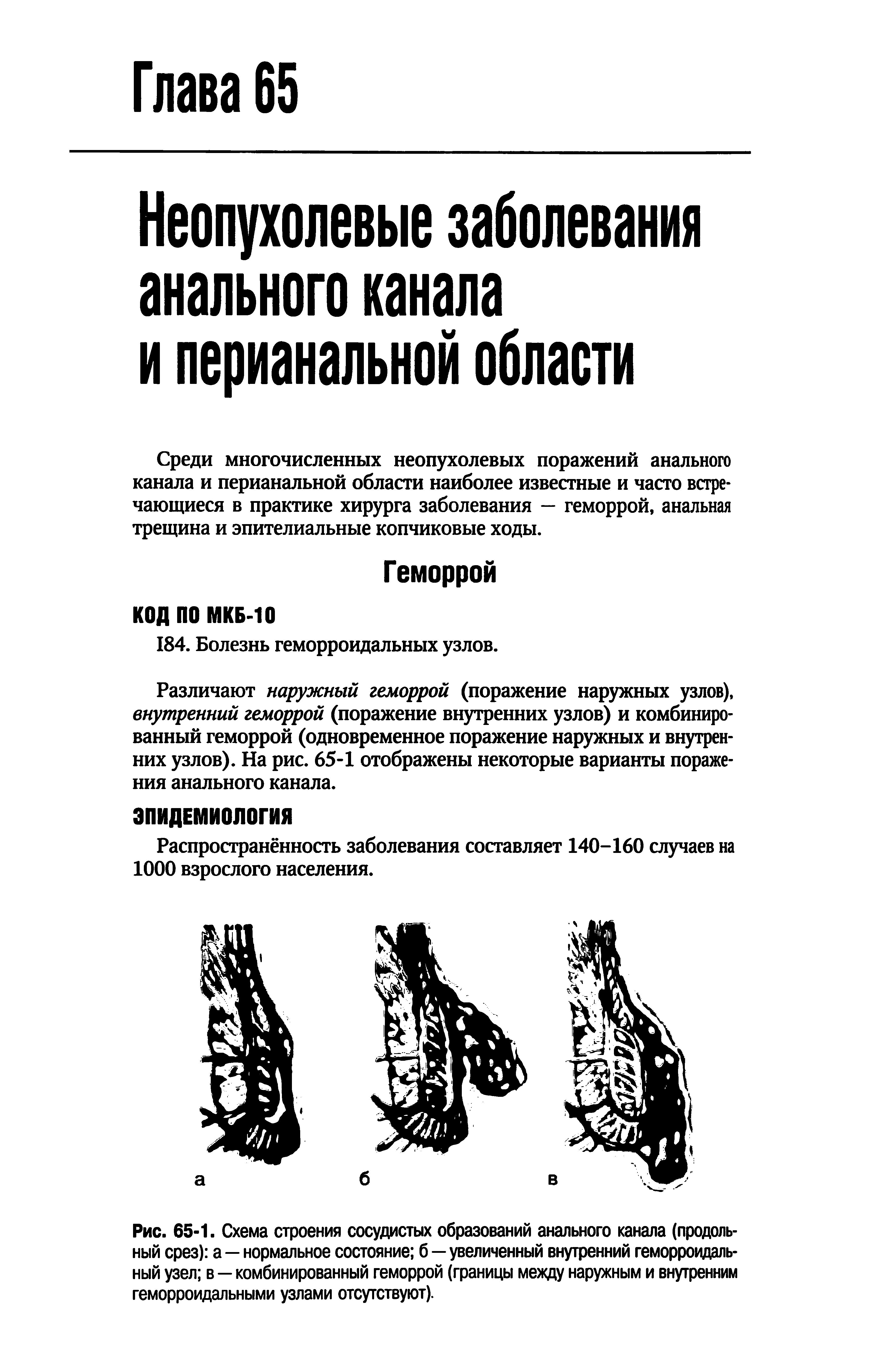 Рис. 65-1. Схема строения сосудистых образований анального канала (продольный срез) а — нормальное состояние б—увеличенный внутренний геморроидальный узел в — комбинированный геморрой (границы между наружным и внутренним геморроидальными узлами отсутствуют).