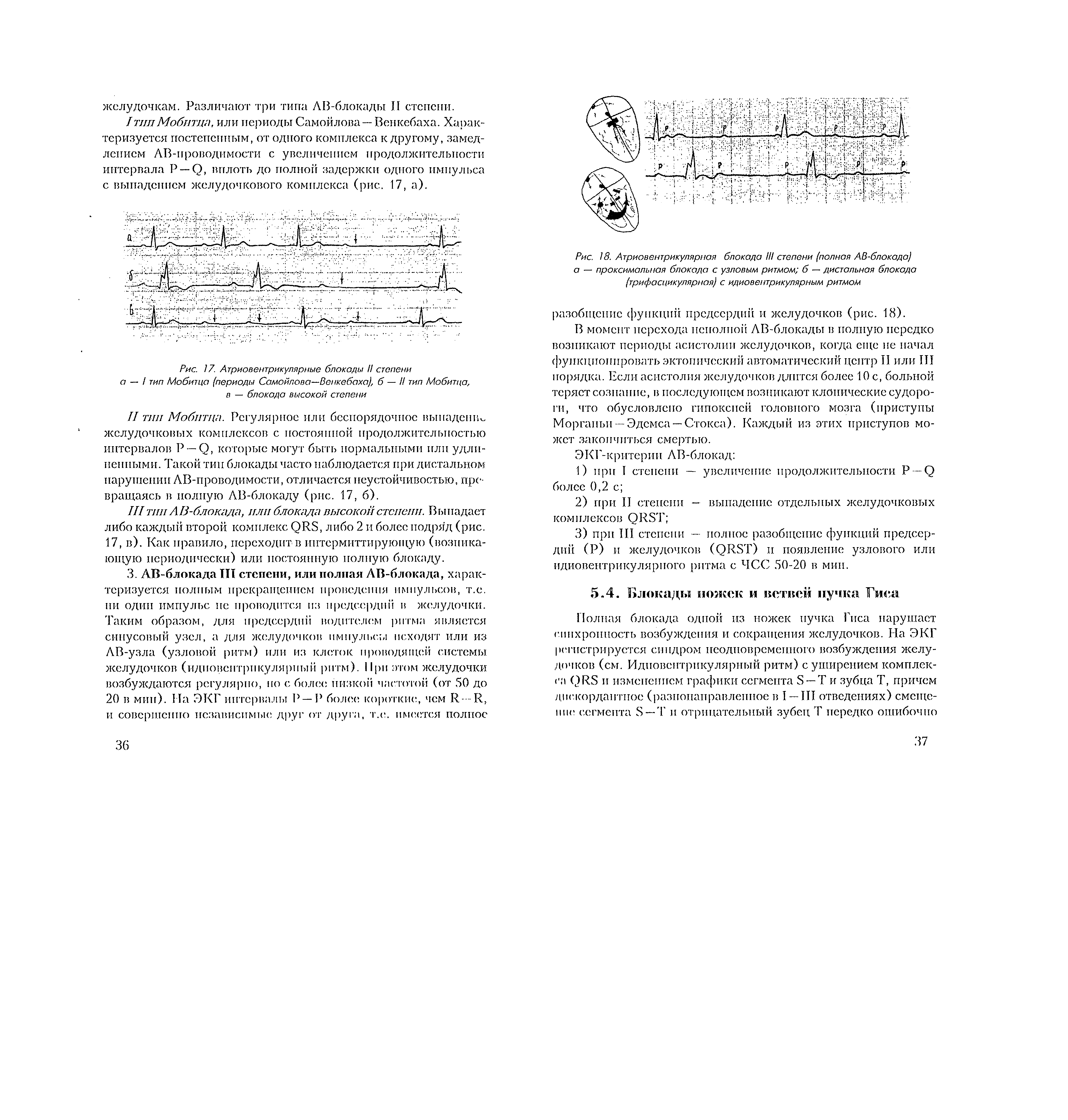 Рис. 18. Атриовентрикулярная блокада III степени (полная АВ-блокада) а — проксимальная блокада с узловым ритмом б — дистальная блокада (трифасцикулярная) с идиовентрикулярным ритмом...