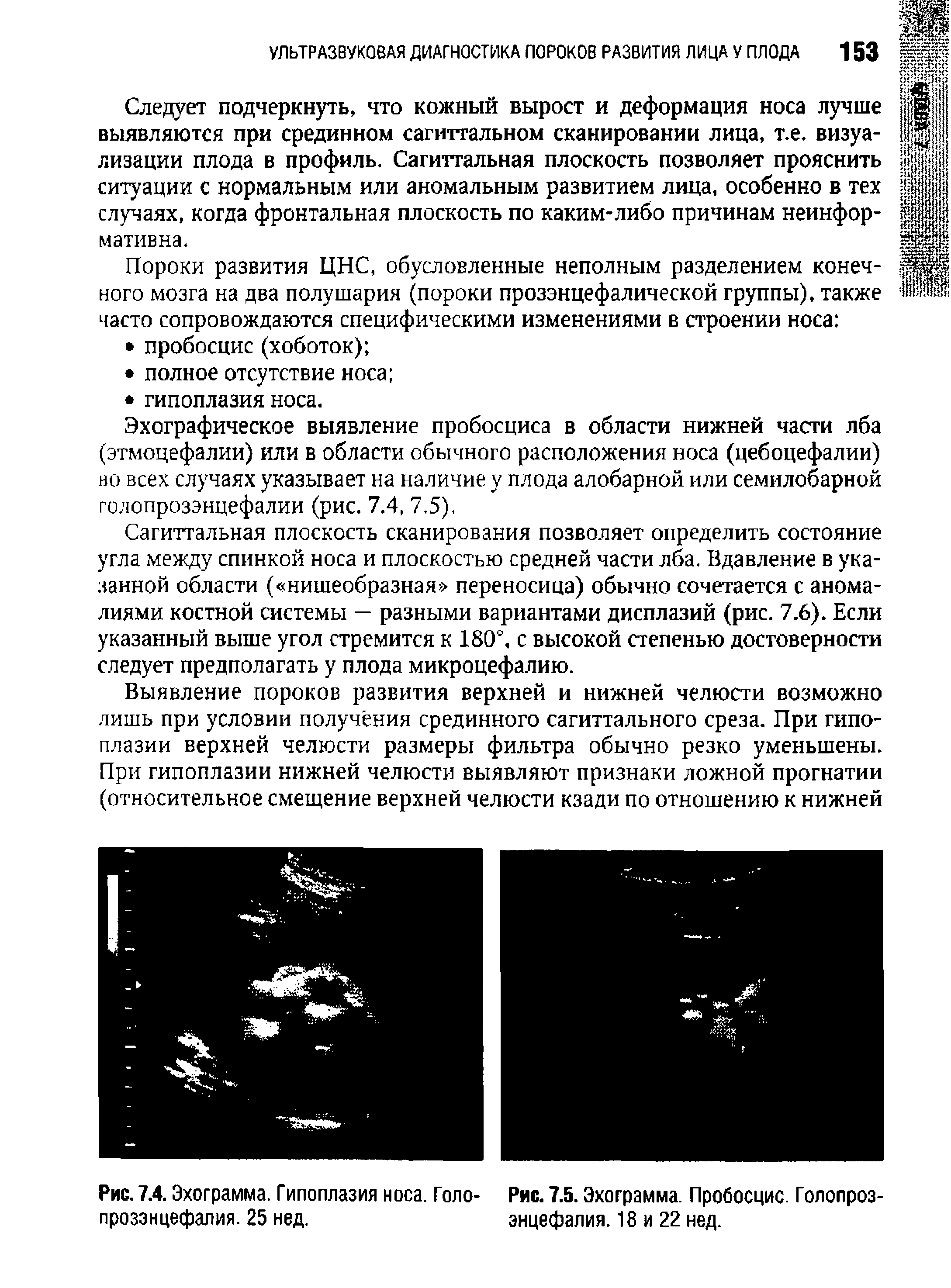 Рис. 7.4. Эхограмма. Гипоплазия носа. Голо- Рис. 7.5. Эхограмма. Пробосцис. Голопроз-...