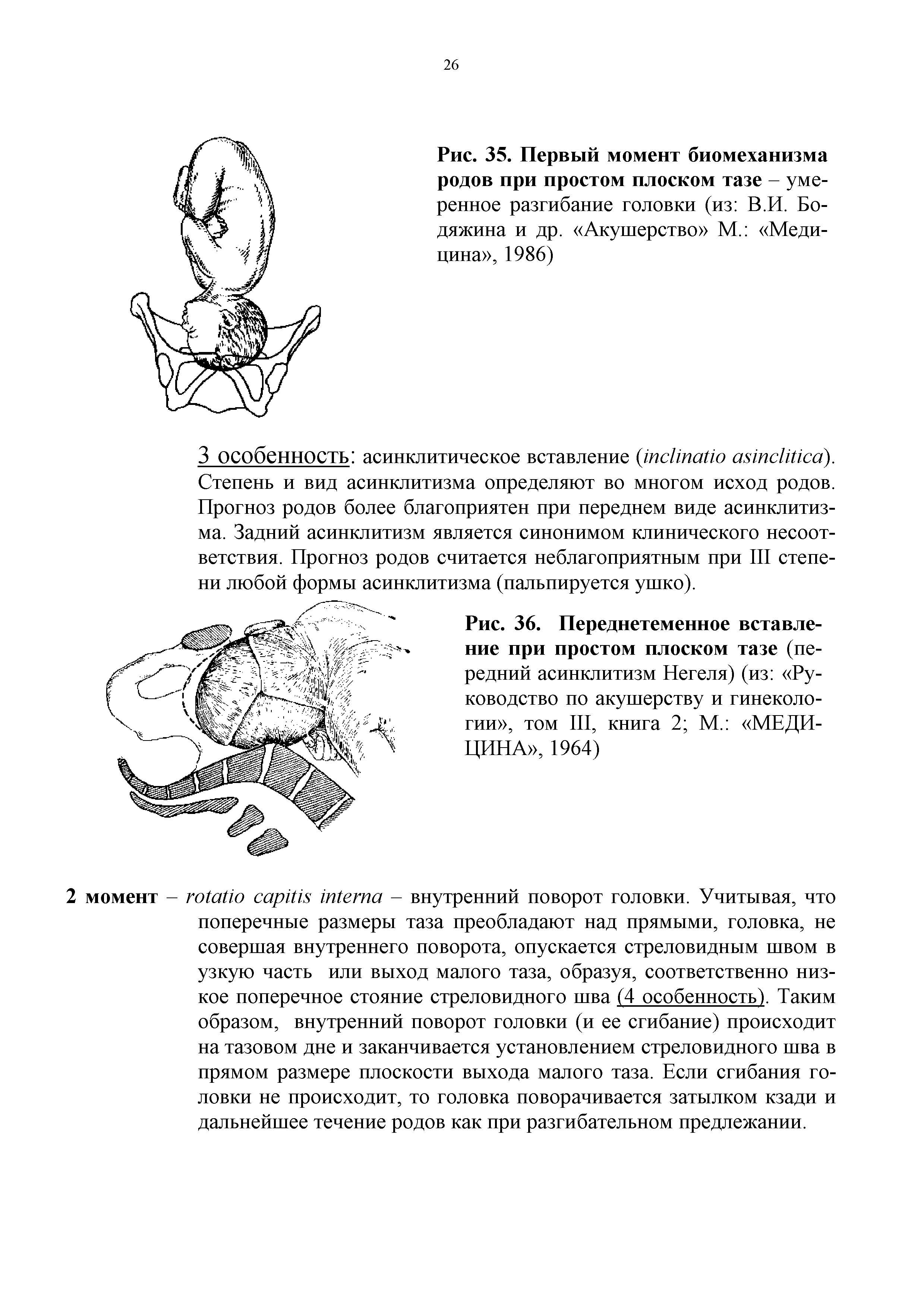 Рис. 36. Переднетеменное вставление при простом плоском тазе (передний асинклитизм Негеля) (из Руководство по акушерству и гинекологии , том III, книга 2 М. МЕДИЦИНА , 1964)...