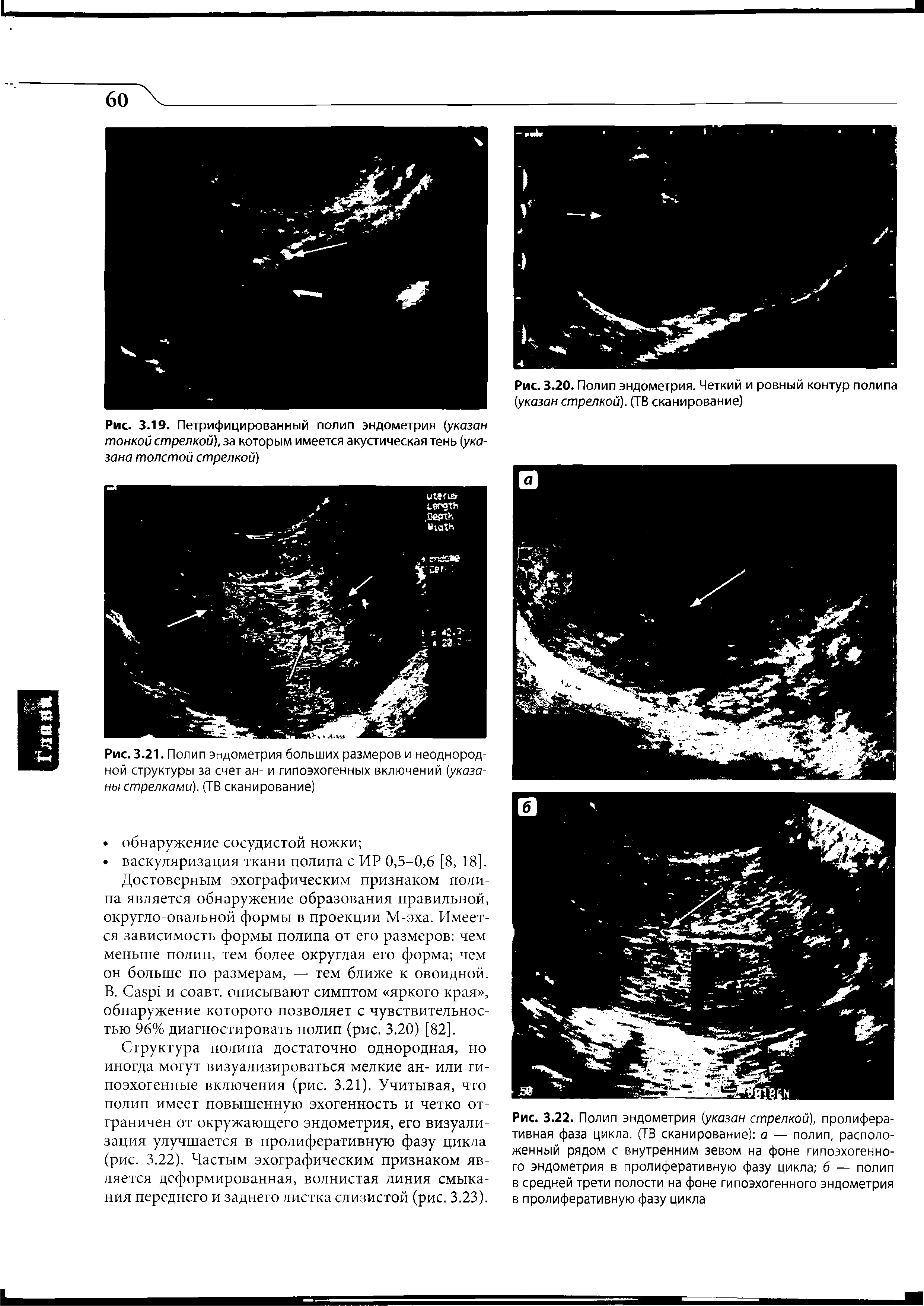 Рис. 3.19. Петрифицированный полип эндометрия (указан тонкой стрелкой), за которым имеется акустическая тень (указана толстой стрелкой)...