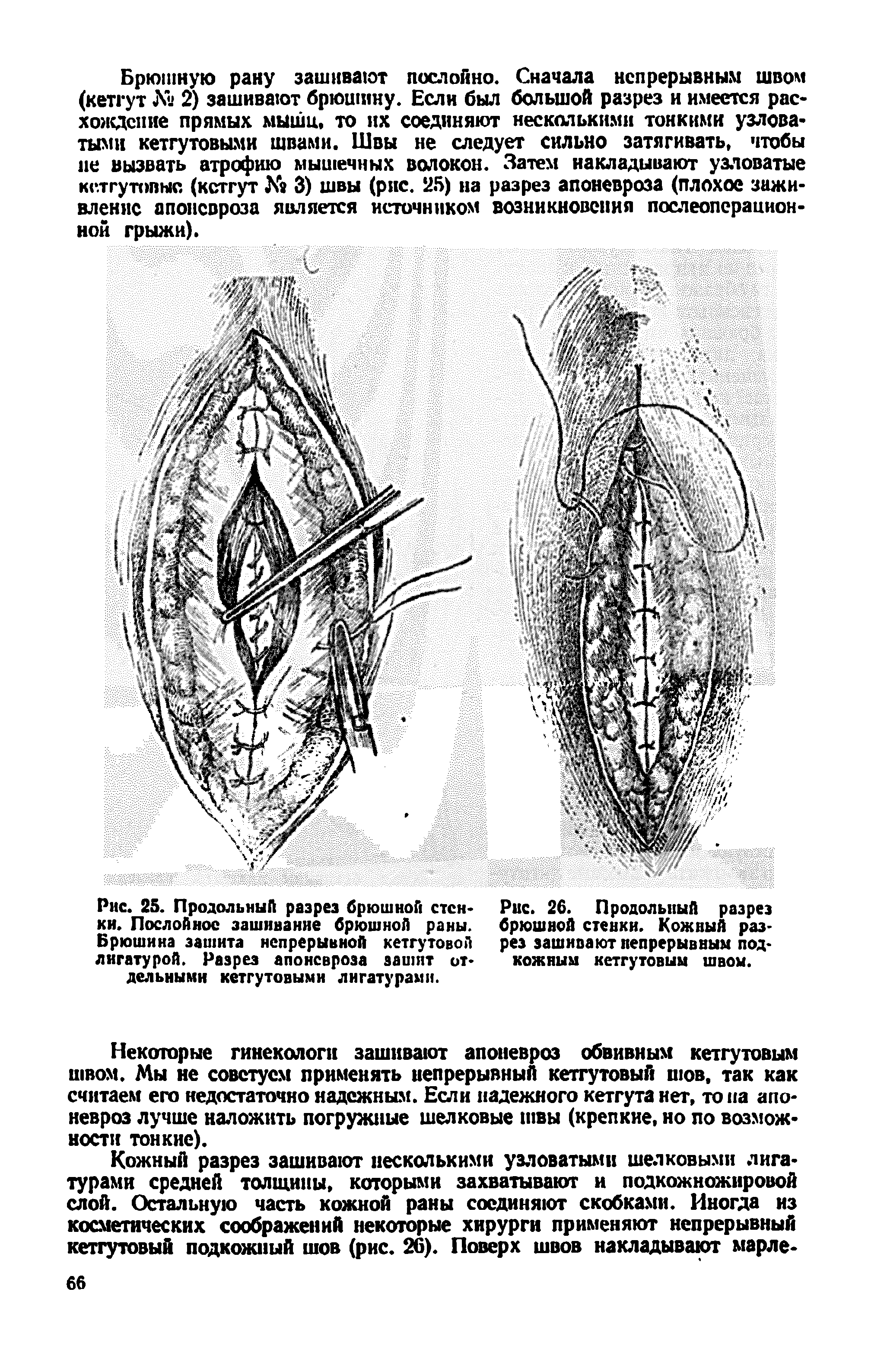 Рис. 25. Продольный разрез брюшной стенки. Послойное зашивание брюшной раны. Брюшина зашита непрерывной кетгутовой лигатурой. Разрез апоневроза зашит отдельными кетгутовыми лигатурами.