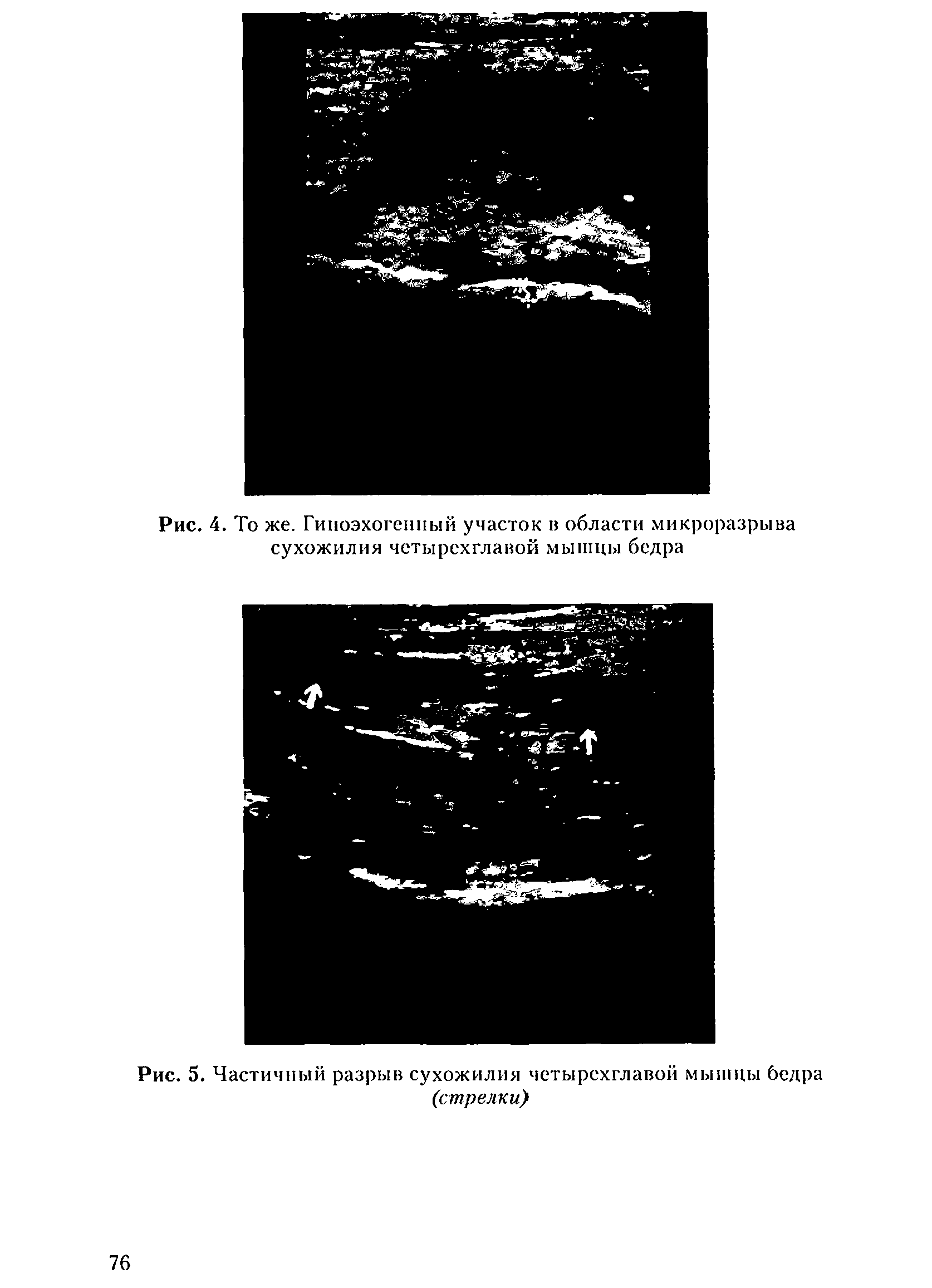 Рис. 5. Частичный разрыв сухожилия четырехглавой мышцы бедра (стрелки)...