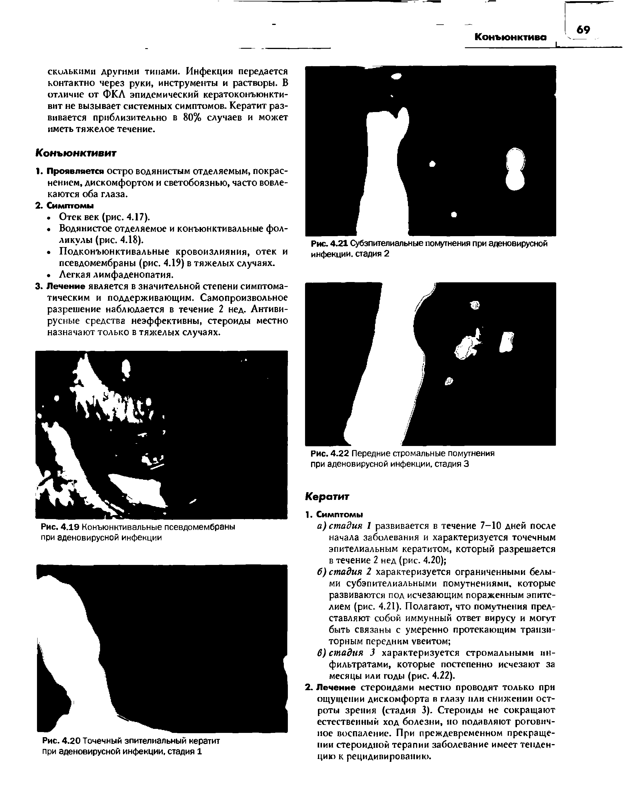 Рис. 4.20 Точечный эпителиальный кератит при аденовирусной инфекции, стадия 1...