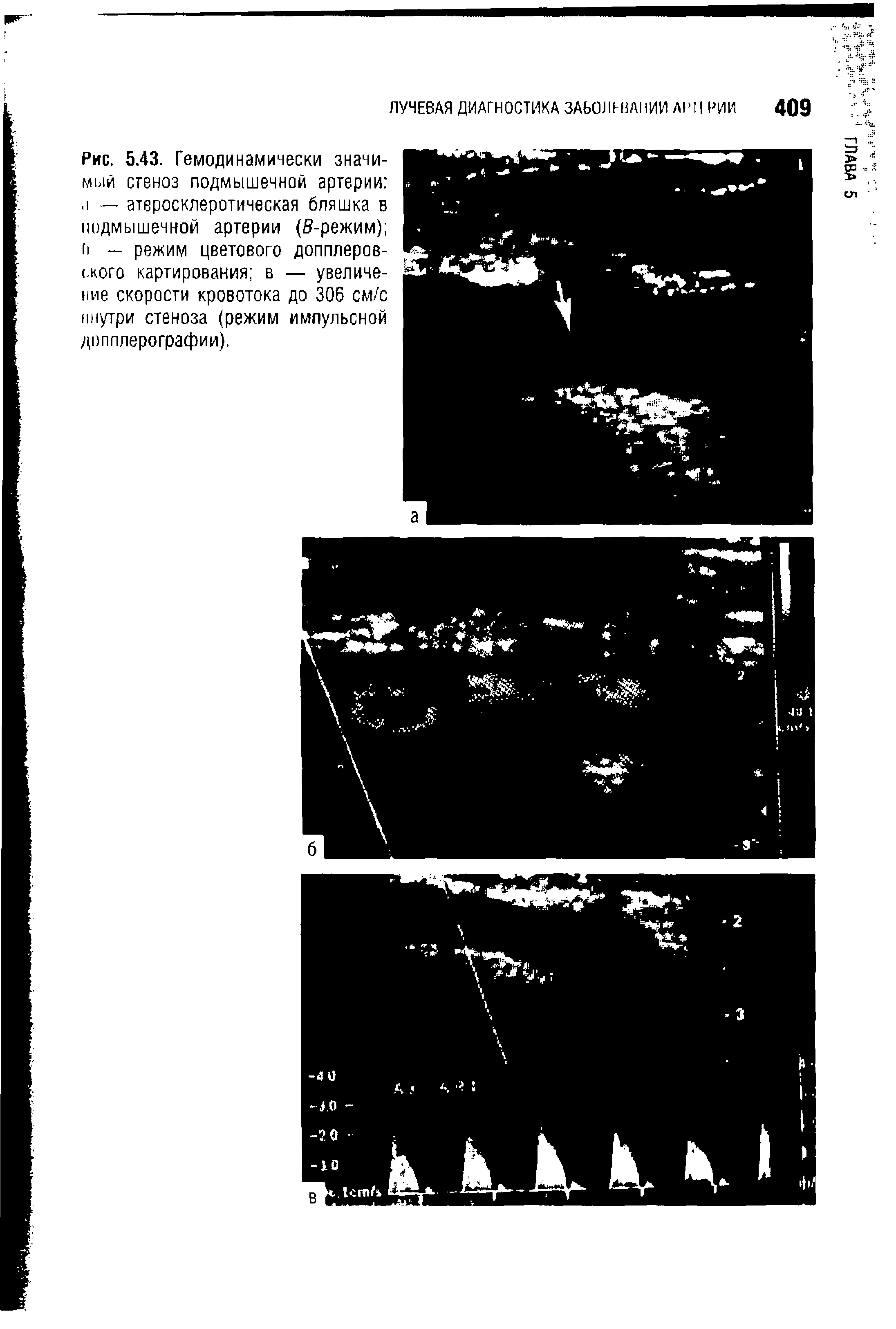 Рис. 5.43. Гемодинамически значимый стеноз подмышечной артерии . 1 — атеросклеротическая бляшка в подмышечной артерии (б-режим) н — режим цветового допплеровского картирования в — увеличение скорости кровотока до 306 см/с ннутри стеноза (режим импульсной допплерографии).