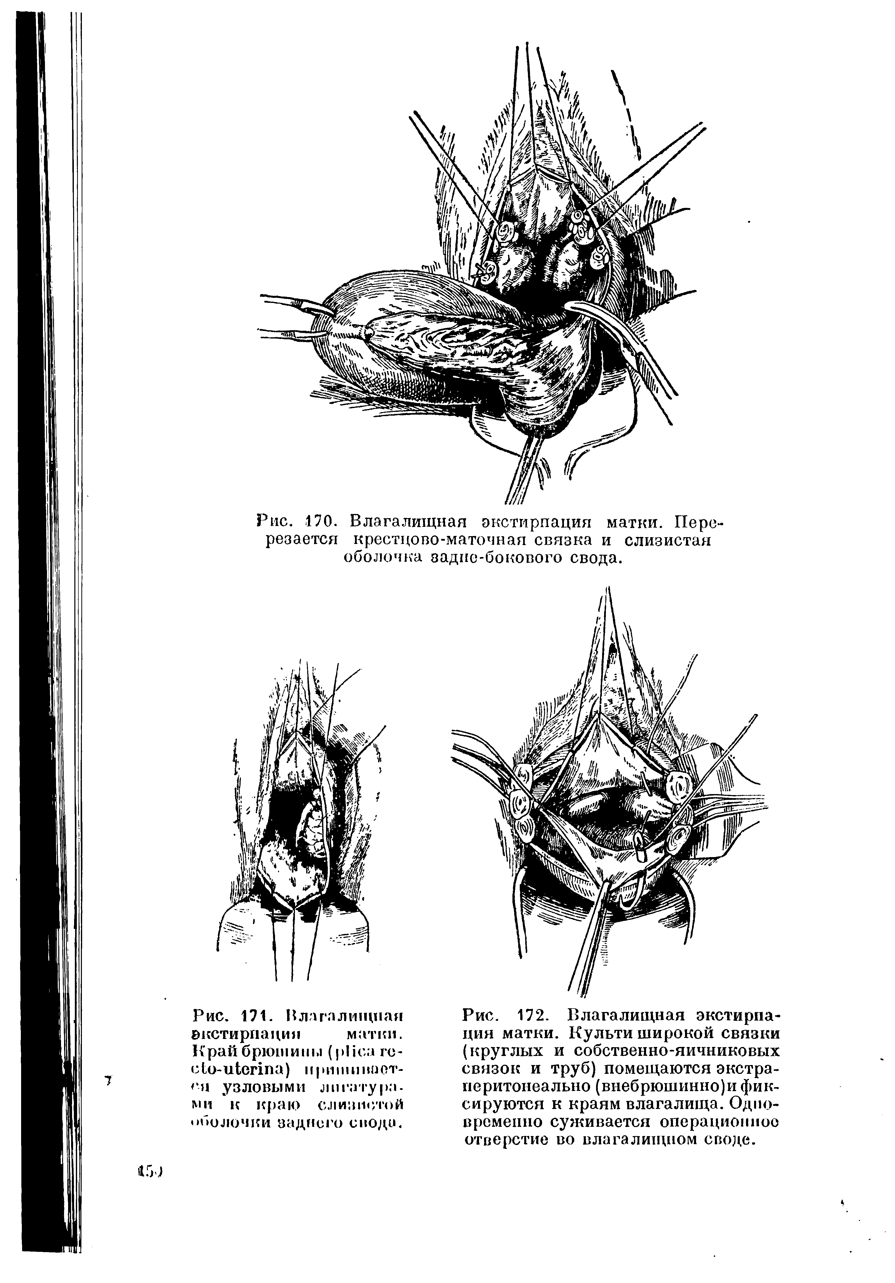 Рис. 172. Влагалищная экстирпация матки. Культи широкой связки (круглых и собственно-яичниковых связок и труб) помещаются экстра-перитонеально (внебрюшинно)и фиксируются к краям влагалища. Одновременно суживается операционное отверстие во влагалищном своде.