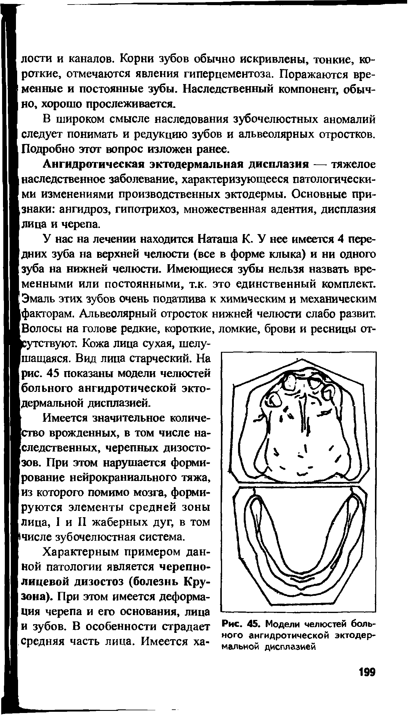 Рис. 45. Модели челюстей больного ангидротической эктодермальной дисплазией...