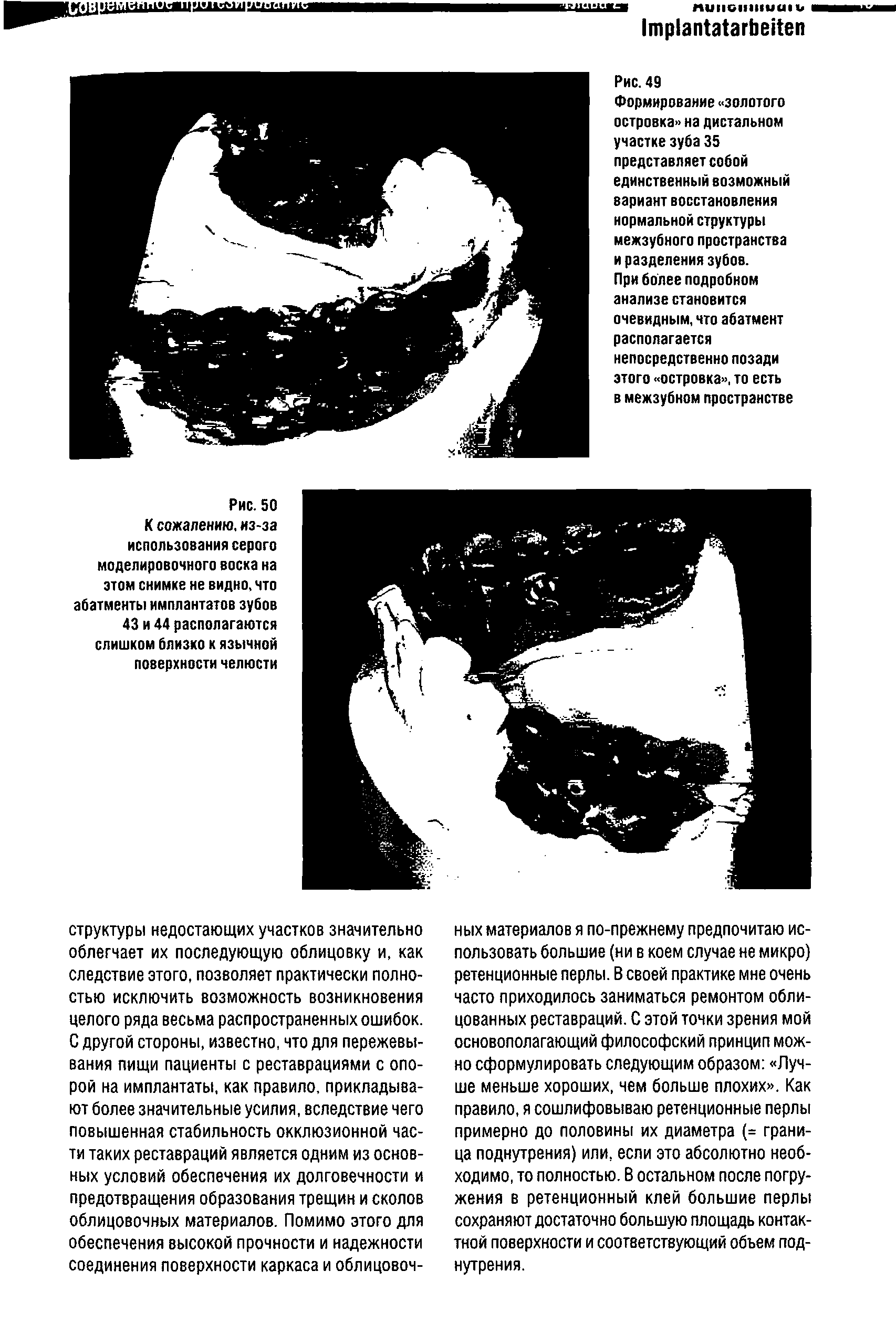 Рис. 50 К сожалению, из-за использования серого моделировочного воска на этом снимке не видно, что абатменты имплантатов зубов 43 и 44 располагаются слишком близко к язычной поверхности челюсти...