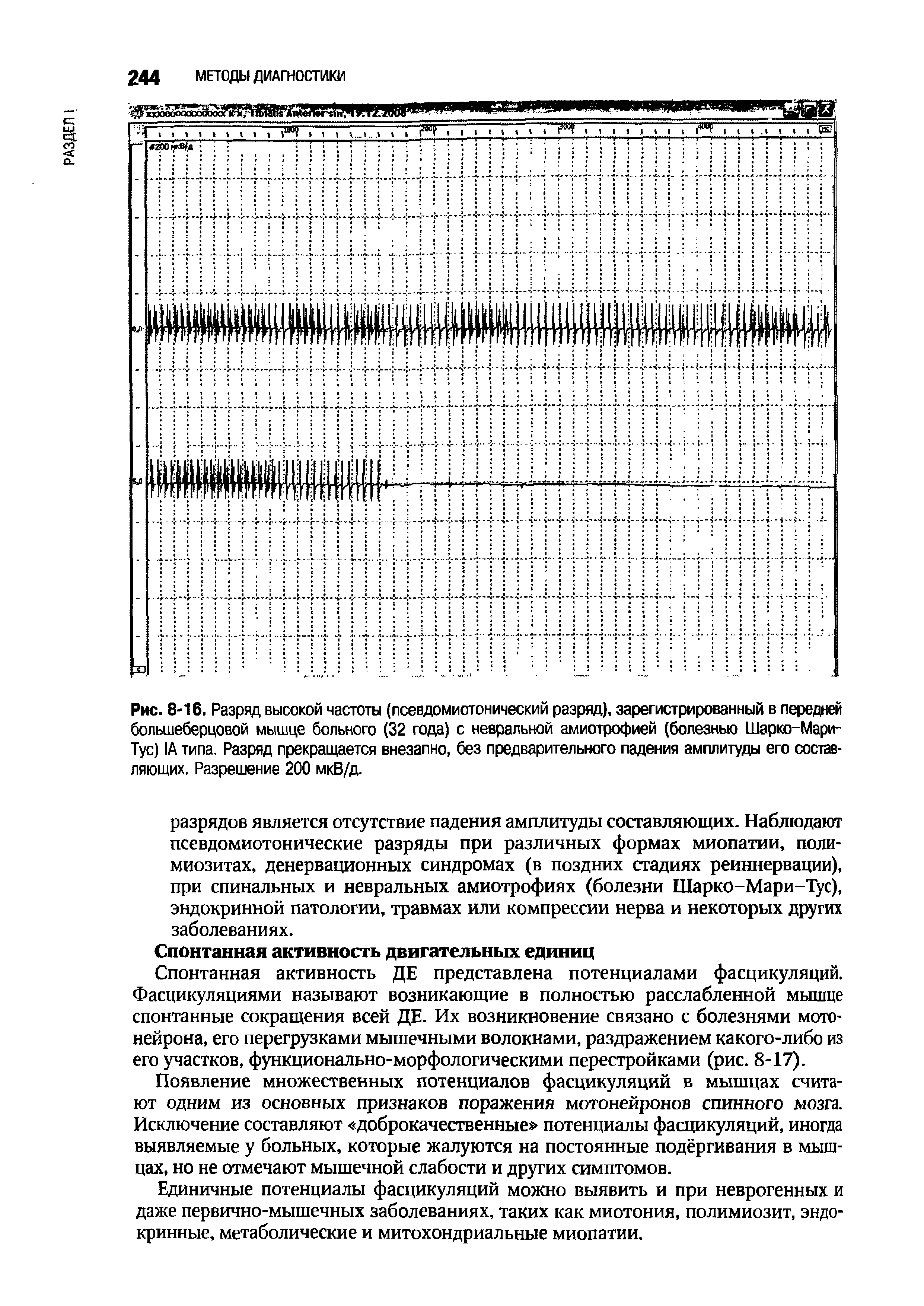 Рис. 8-16. Разряд высокой частоты (псевдомиотонический разряд), зарегистрированный в передней большеберцовой мышце больного (32 года) с невральной амиотрофией (болезнью Шарко-Мари-Тус) 1А типа. Разряд прекращается внезапно, без предварительного падения амплитуды его составляющих. Разрешение 200 мкВ/д.
