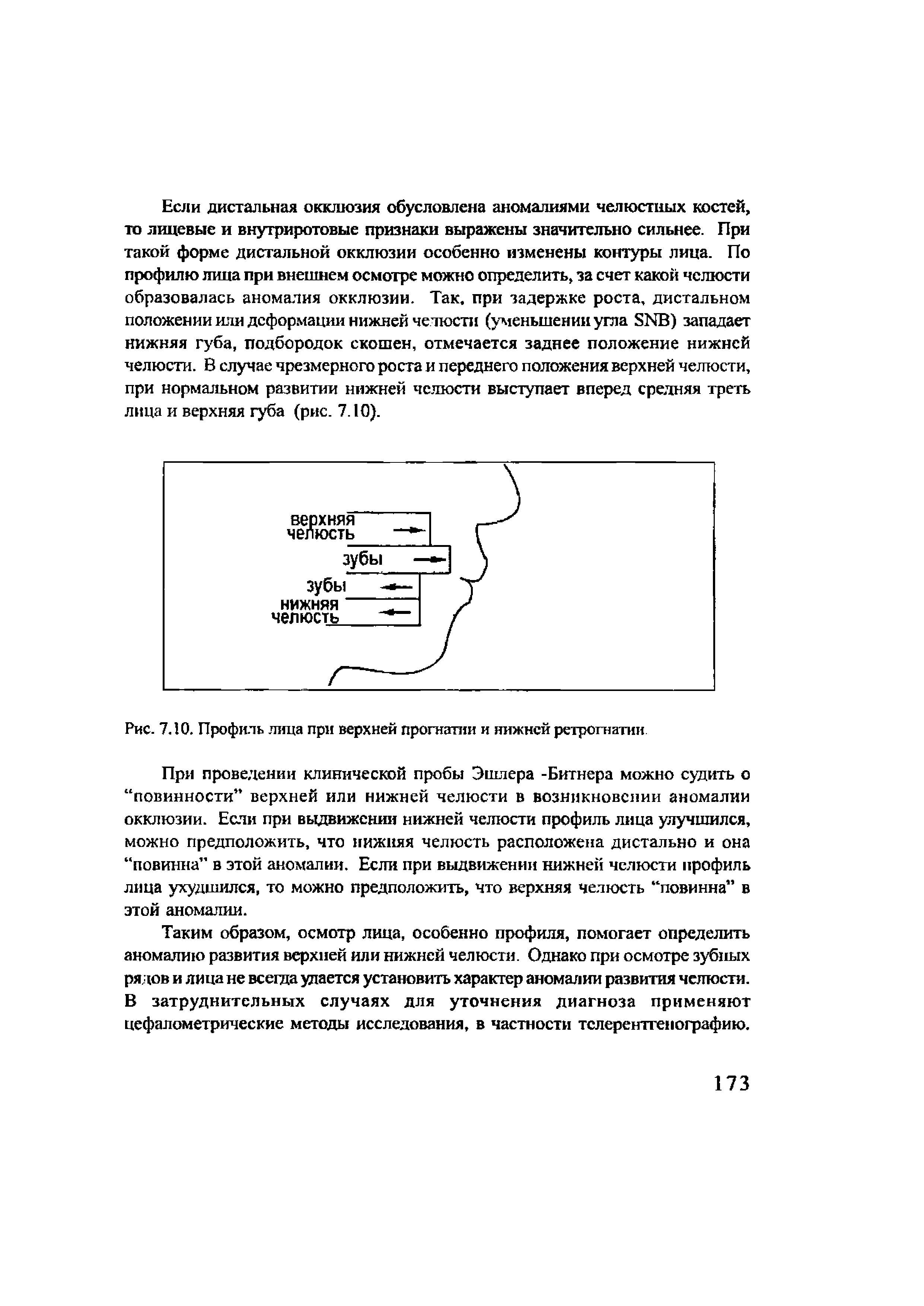 Рис. 7.10. Профиль лица при верхней прогнатии и нижней ретрогнатии...