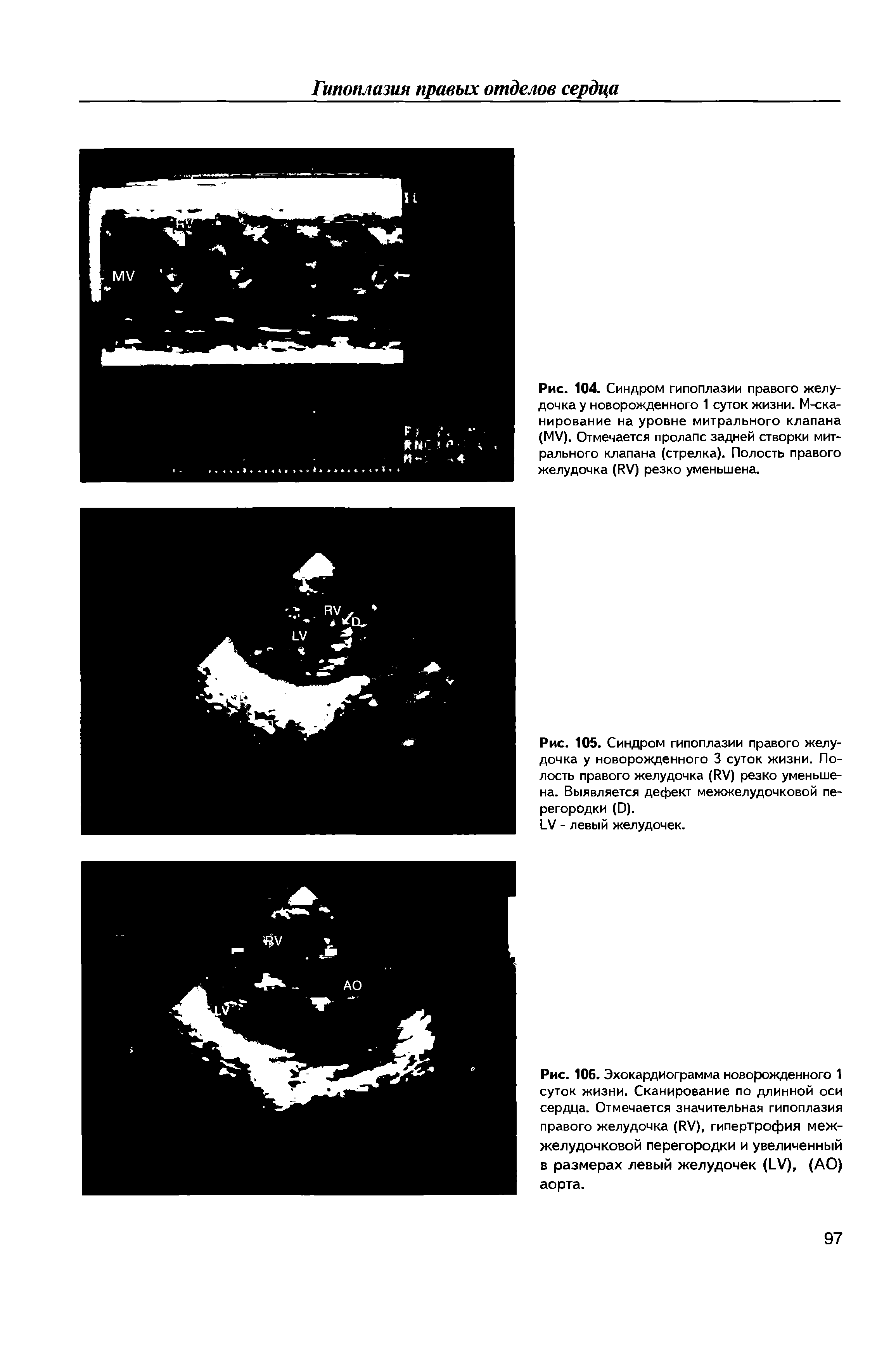 Рис. 106. Эхокардиограмма новорожденного 1 суток жизни. Сканирование по длинной оси сердца. Отмечается значительная гипоплазия правого желудочка (РУ), гипертрофия межжелудочковой перегородки и увеличенный в размерах левый желудочек (1 У), (АО) аорта.