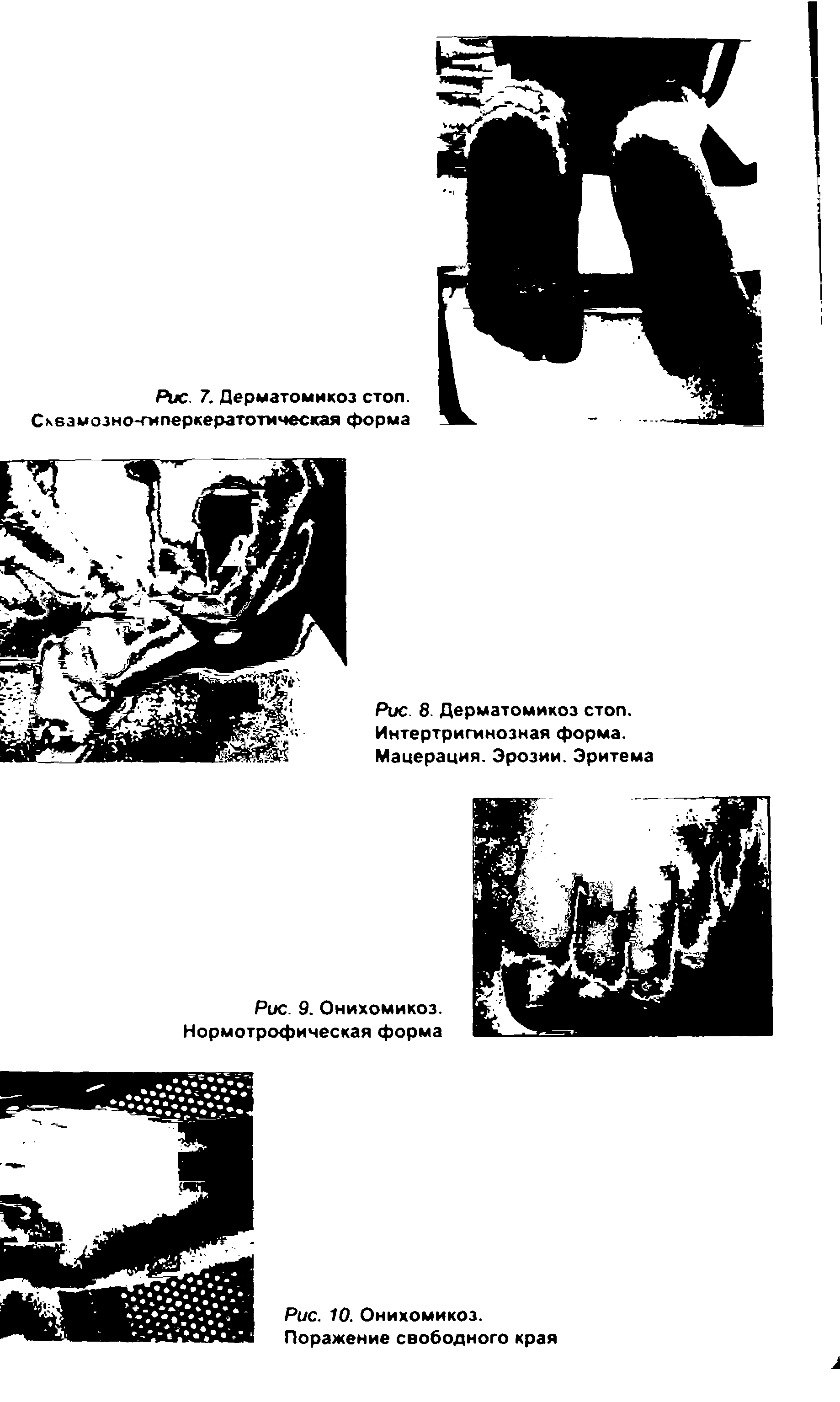 Рис. 8. Дерматомикоз стоп. Интертригинозная форма. Мацерация. Эрозии. Эритема...