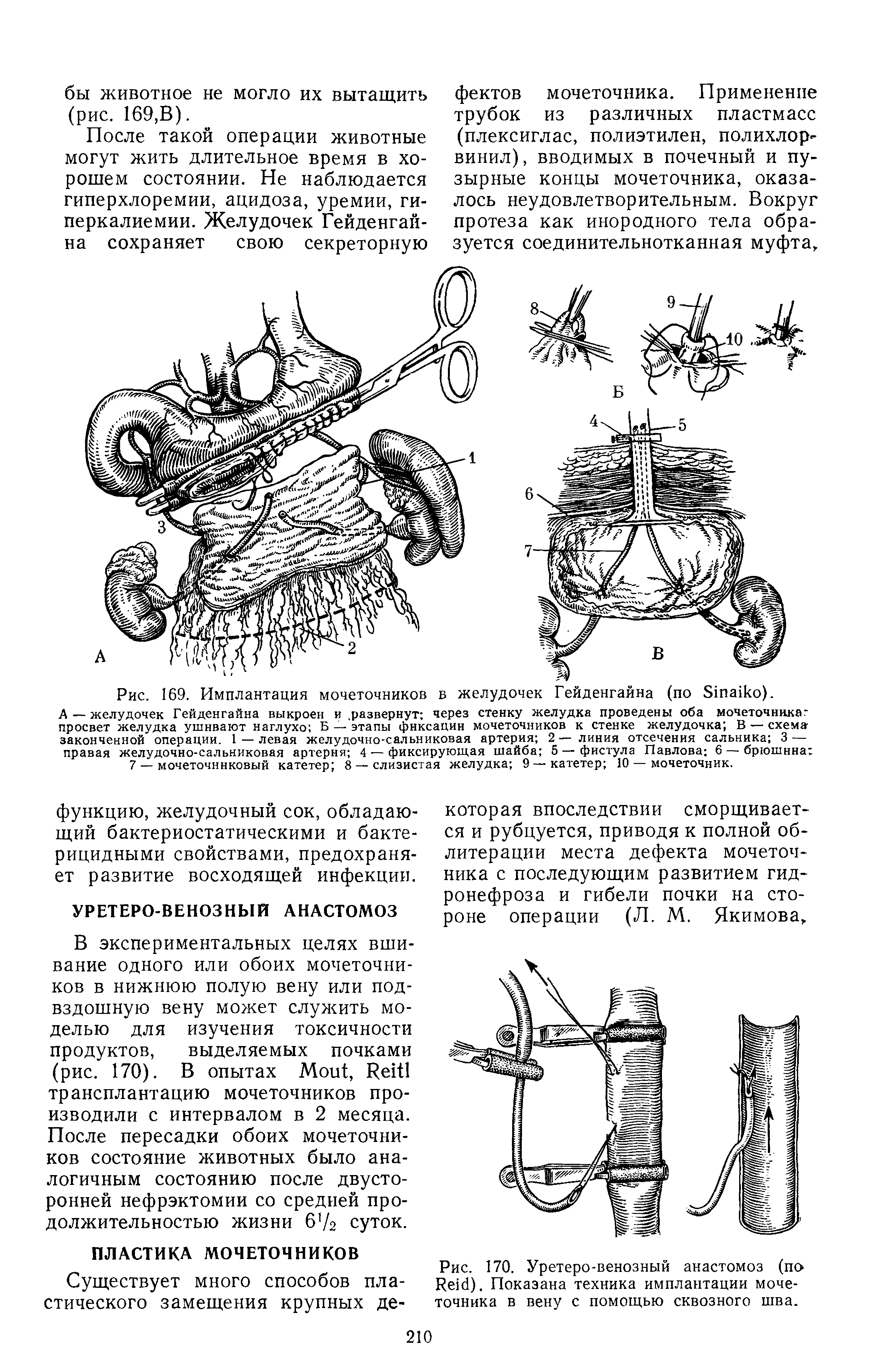 Рис. 170. Уретеро-венозный анастомоз (по R ). Показана техника имплантации мочеточника в вену с помощью сквозного шва.