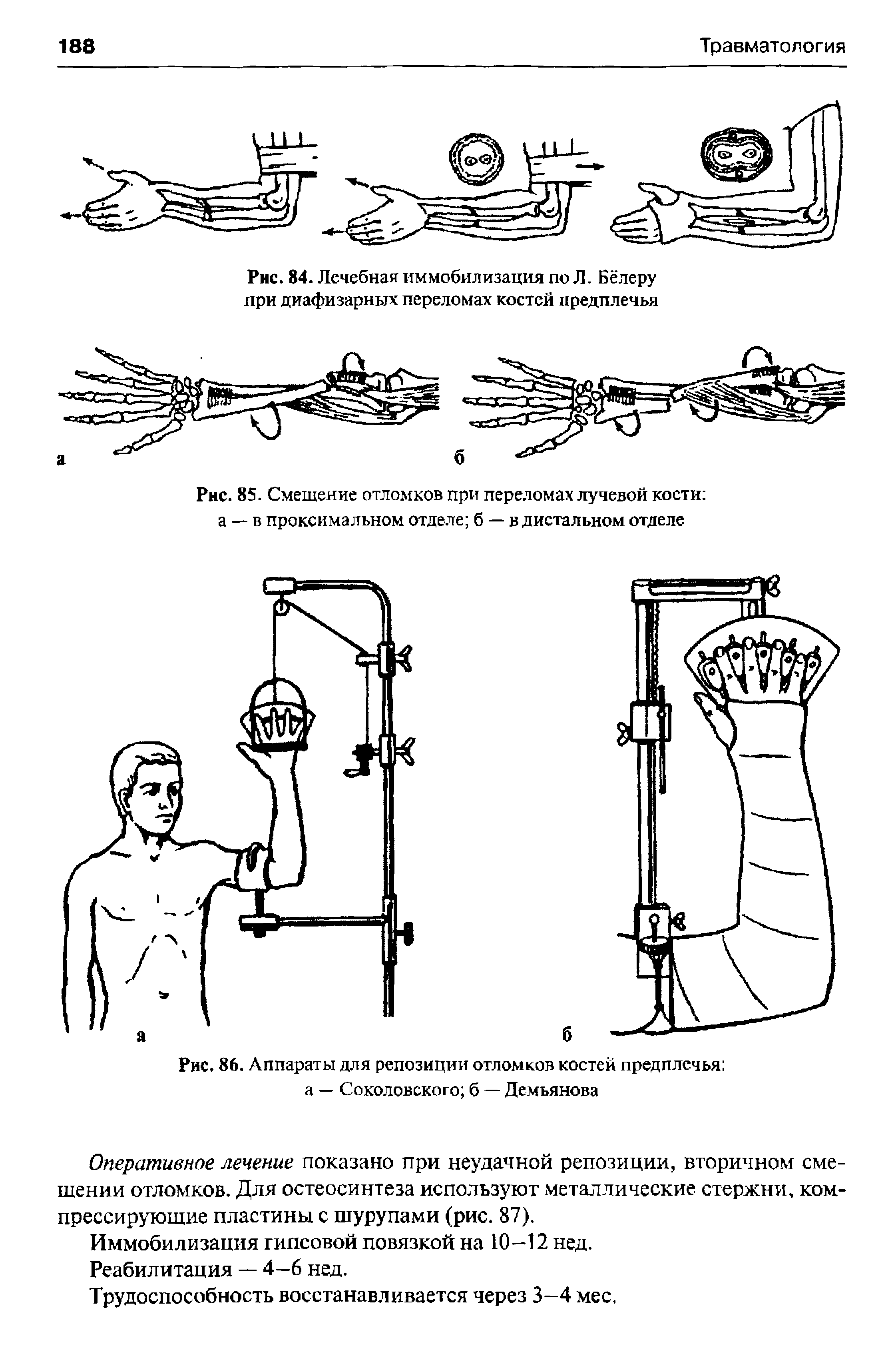 Рис. 86. Аппараты для репозиции отломков костей предплечья а — Соколовского б — Демьянова...