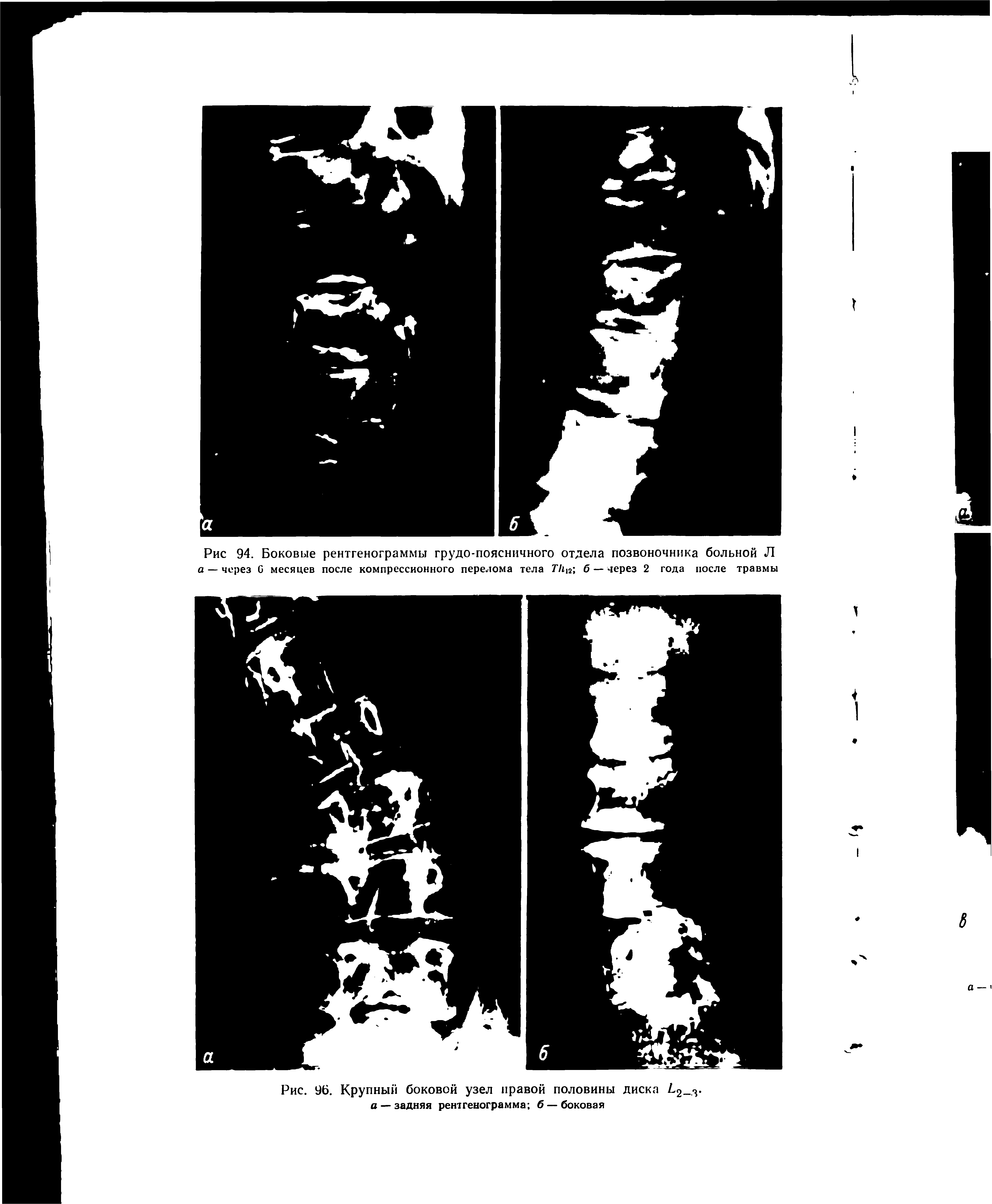 Рис. 96. Крупный боковой узел правой половины диска 2-з-а — задняя рентгенограмма б — боковая...