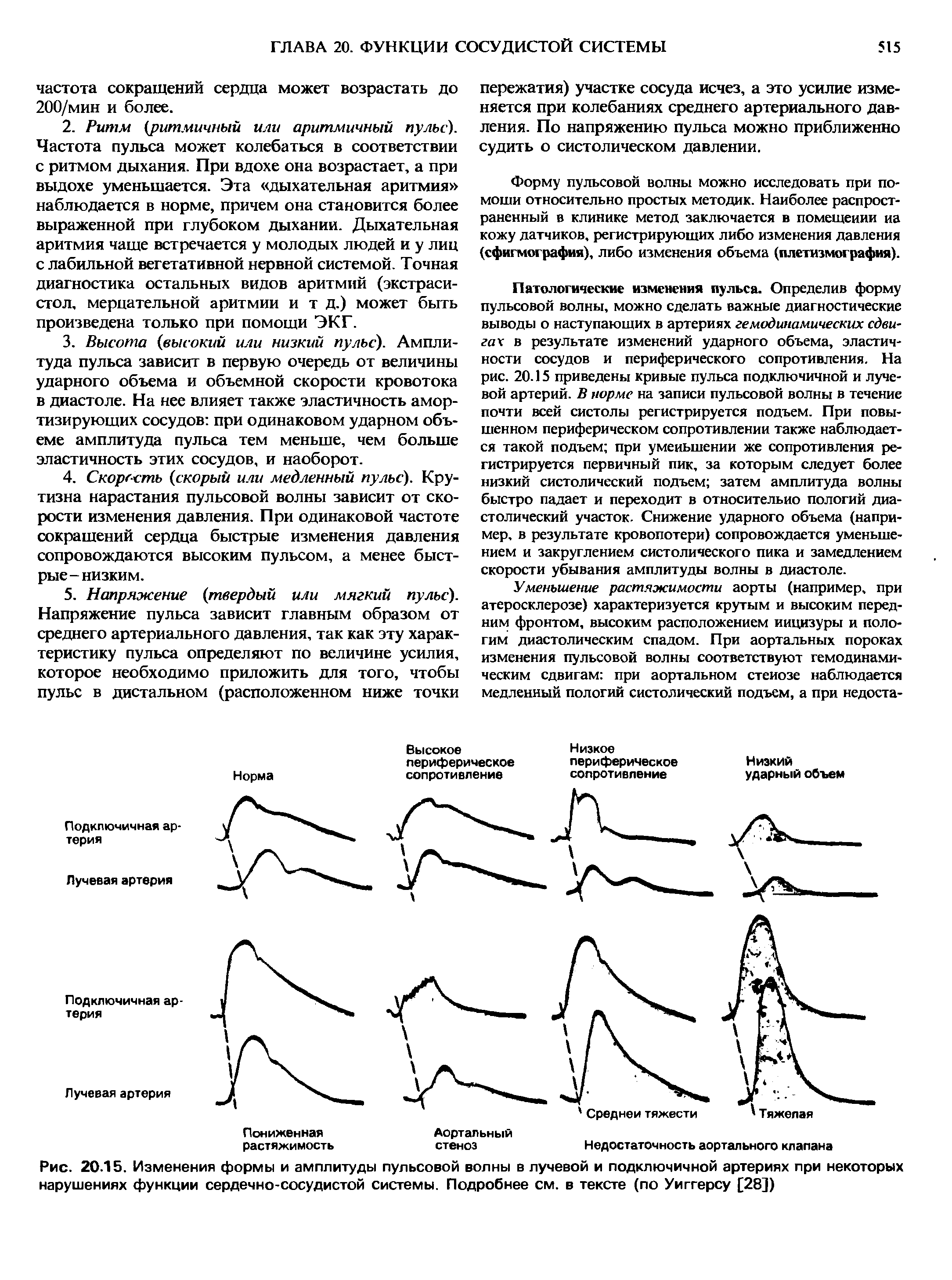 Рис. 20.15. Изменения формы и амплитуды пульсовой волны в лучевой и подключичной артериях при некоторых нарушениях функции сердечно-сосудистой системы. Подробнее см. в тексте (по Уиггерсу [28])...