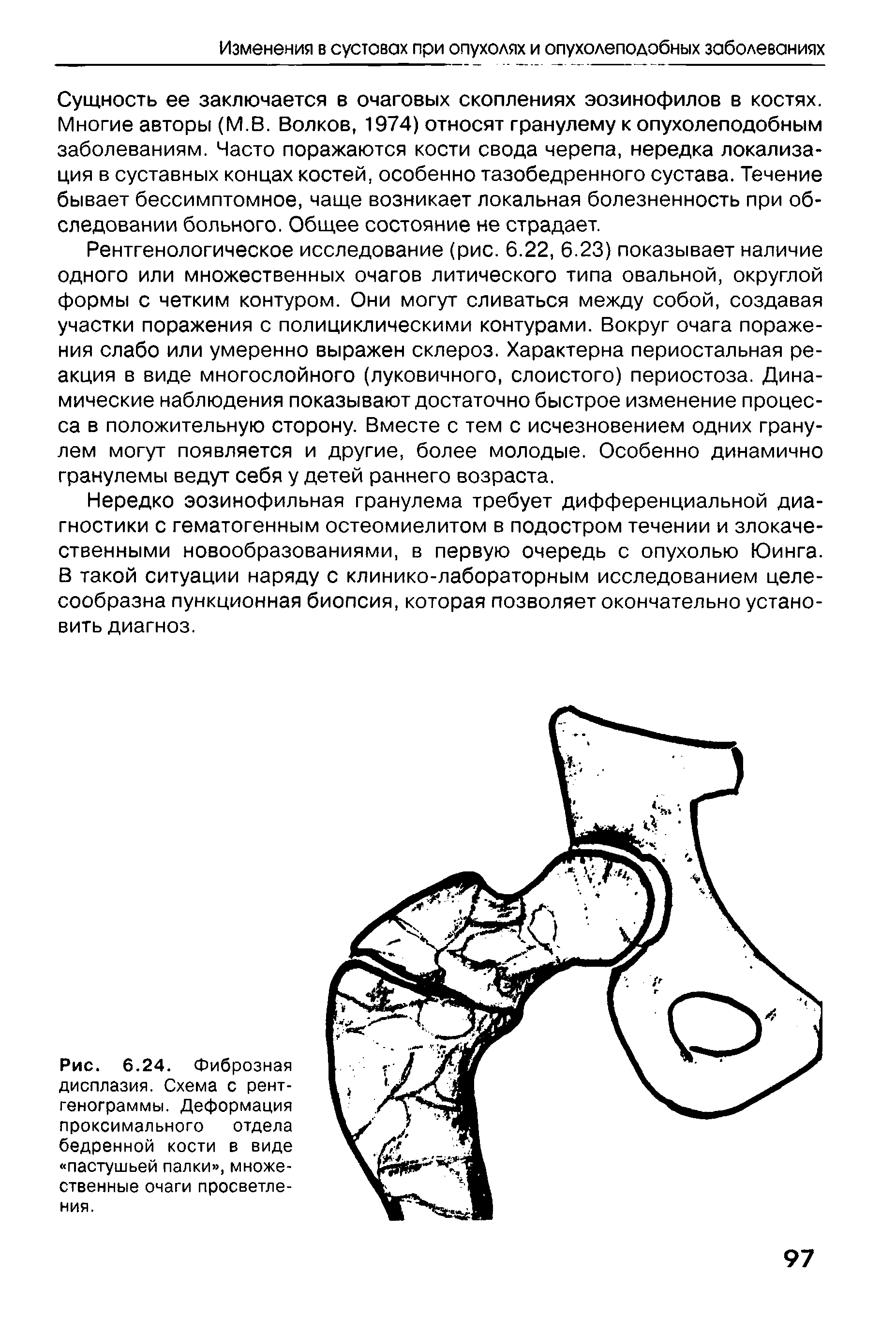 Рис. 6.24. Фиброзная дисплазия. Схема с рентгенограммы. Деформация проксимального отдела бедренной кости в виде пастушьей палки , множественные очаги просветления.