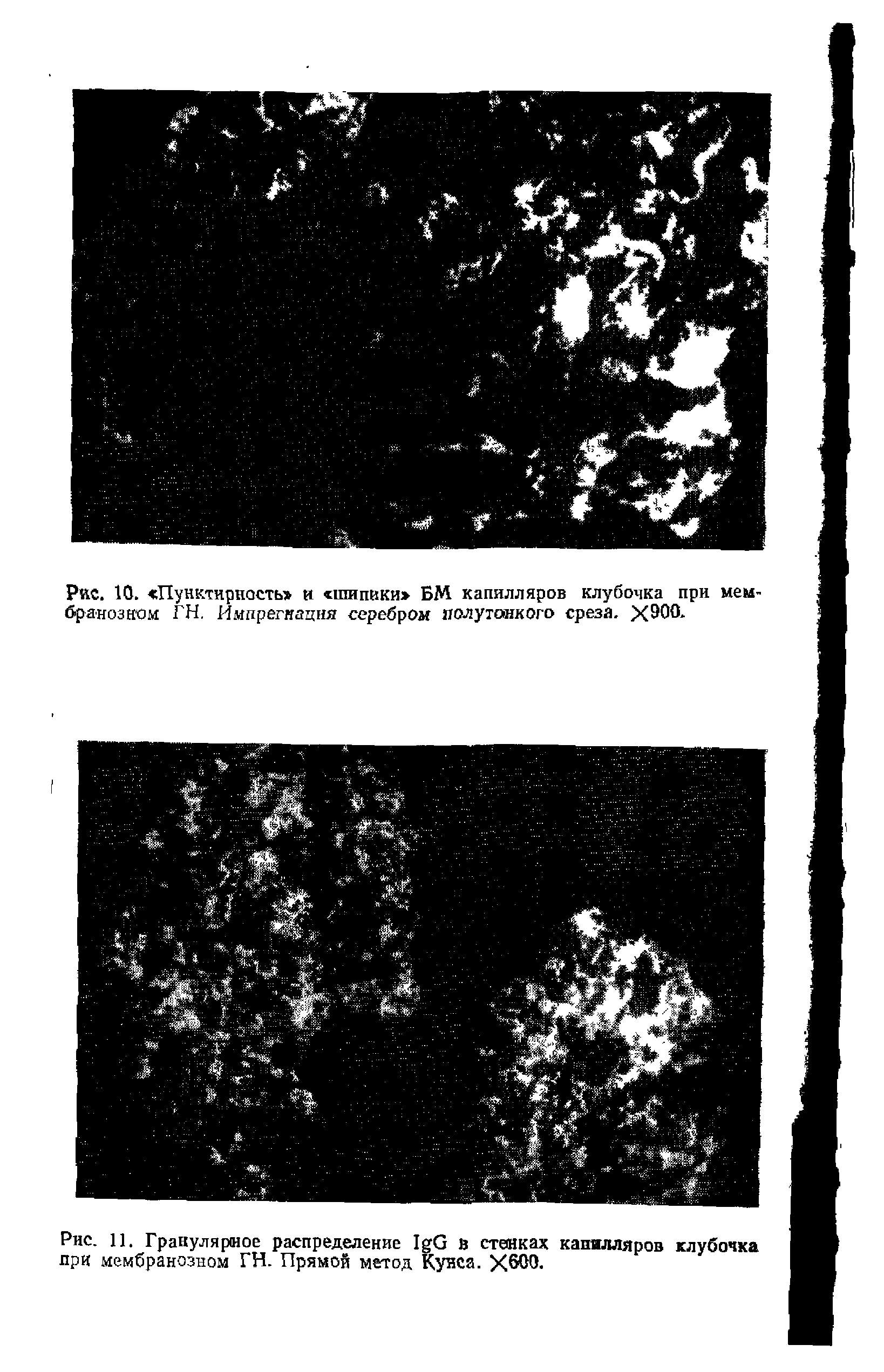 Рис. 11. Гранулярмое распределение I G В стенках капилляров клубочка при мембранозном ГН. Прямой метод Кунса. Х600.