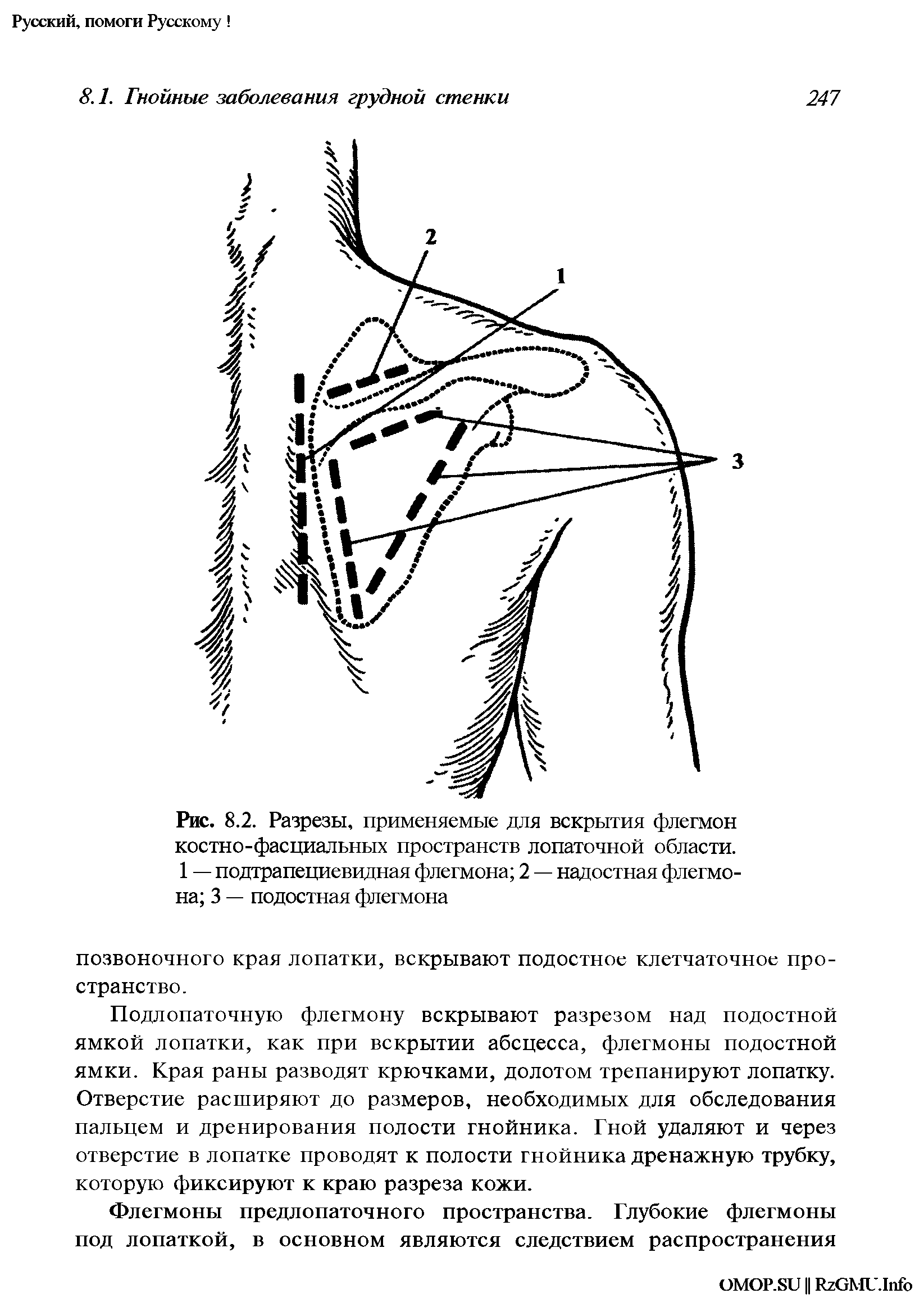 Рис. 8.2. Разрезы, применяемые для вскрытия флегмон костно-фасциальных пространств лопаточной области. 1 — подтрапециевидная флегмона 2 — надостная флегмона 3 — подостная флегмона...