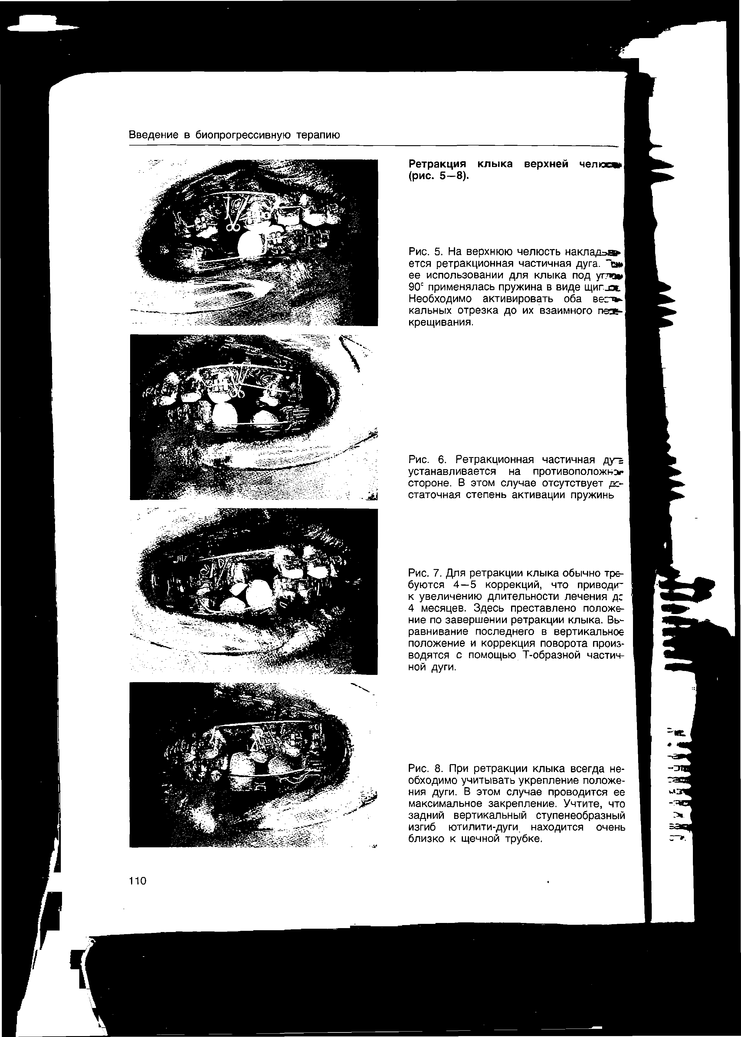 Рис. 7. Для ретракции клыка обычно требуются 4—5 коррекций, что приводи к увеличению длительности лечения дс 4 месяцев. Здесь преставлено положение по завершении ретракции клыка. Вь-равнивание последнего в вертикальное положение и коррекция поворота производятся с помощью Т-образной частичной дуги.