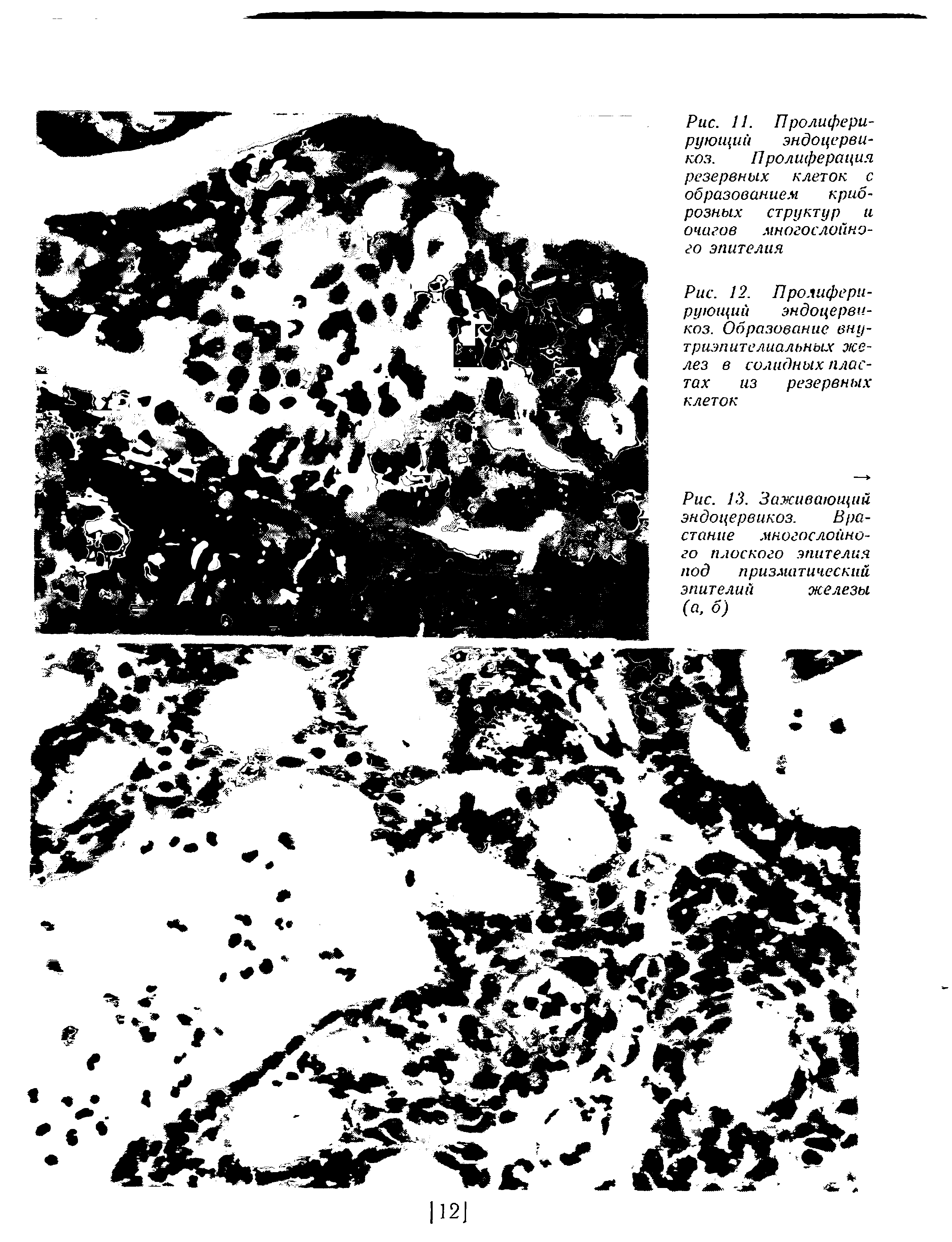 Рис. 12. Пролиферирующий эндоцерви-коз. Образование вну-т р нэп и те ли альн ых желез в солидных пластах из резервных клеток...