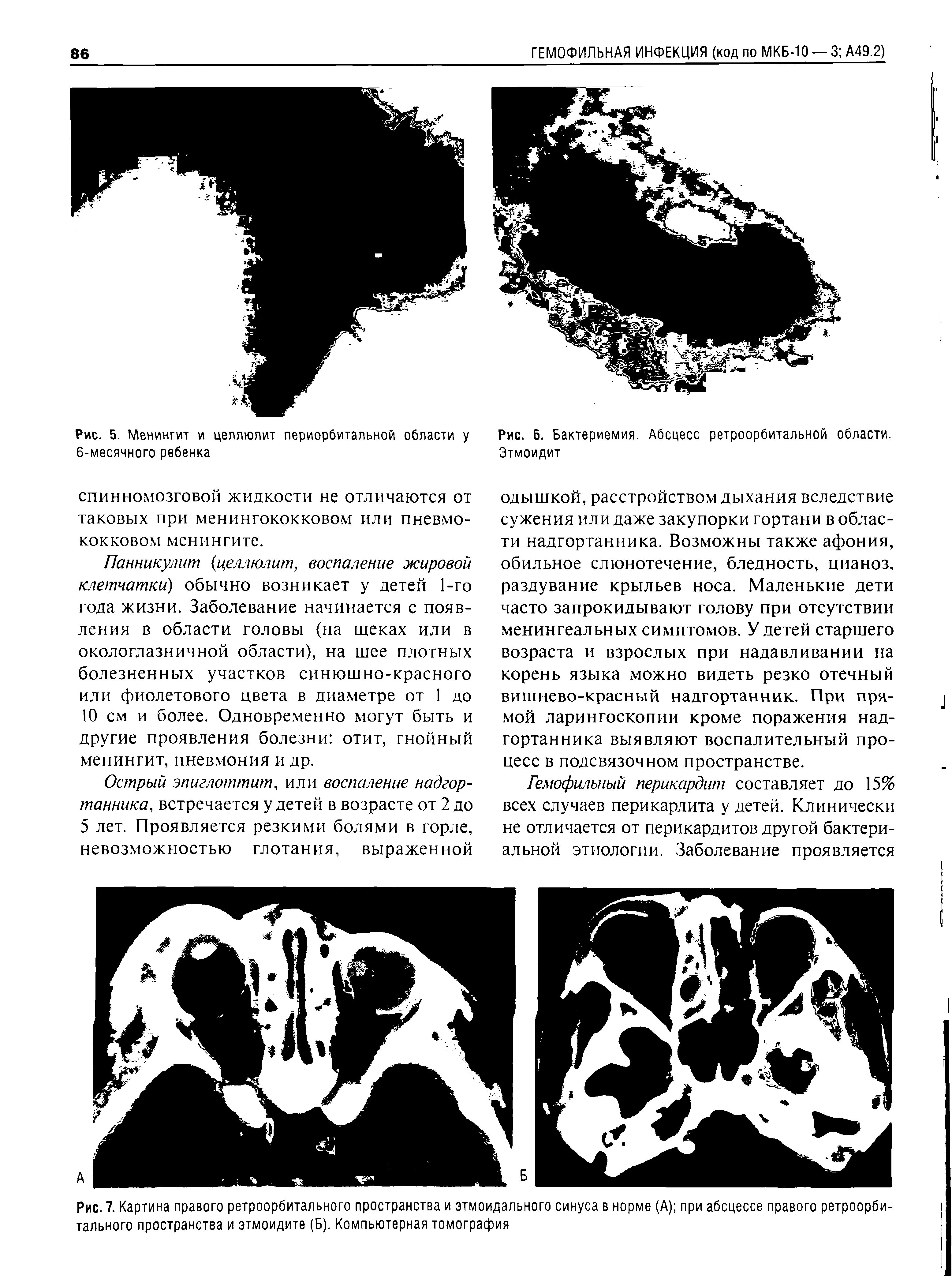 Рис. 7. Картина правого ретроорбитального пространства и этмоидального синуса в норме (А) при абсцессе правого ретроорби-тального пространства и этмоидите (Б). Компьютерная томография...