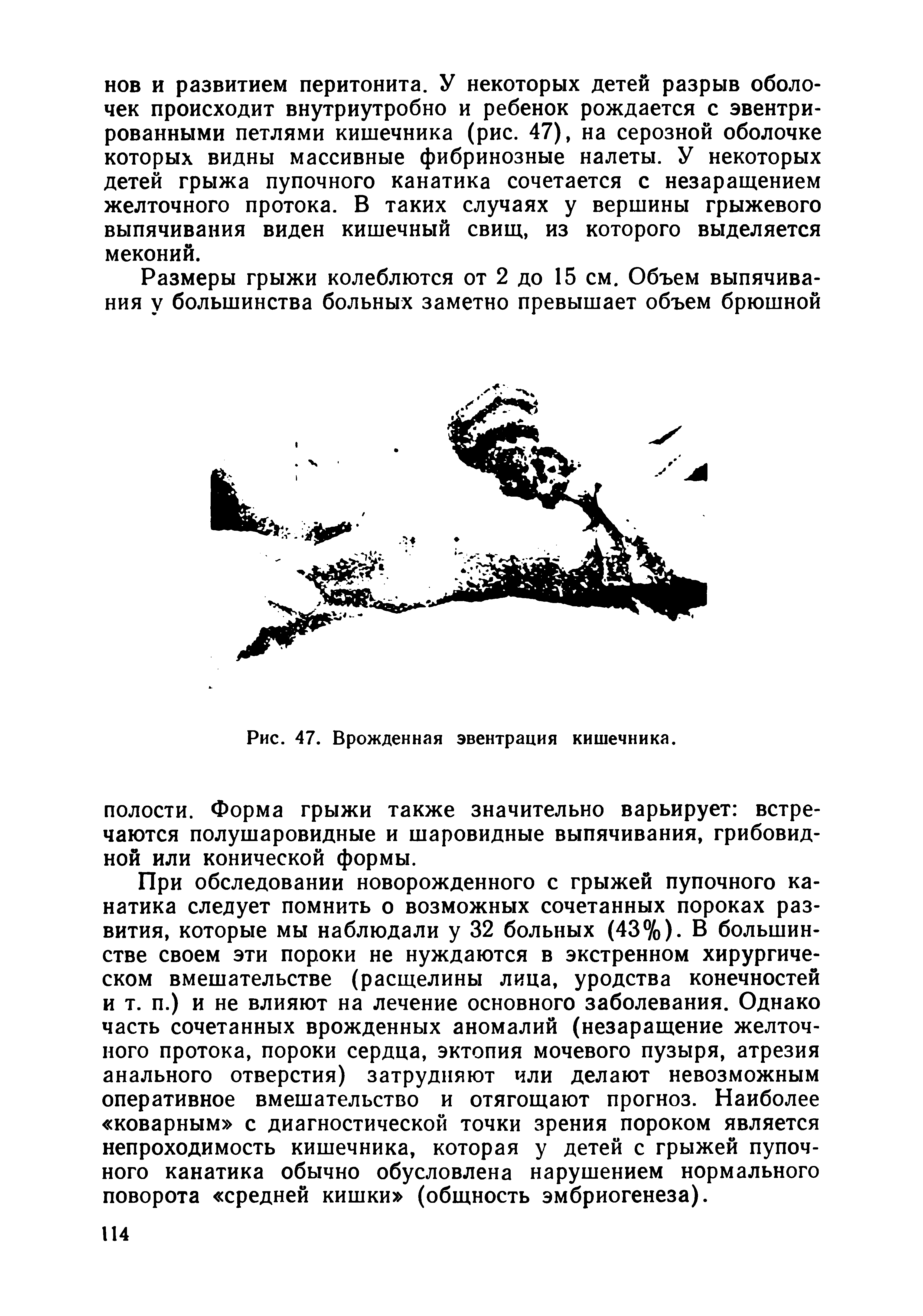 Рис. 47. Врожденная эвентрация кишечника, полости. Форма грыжи также значительно варьирует встречаются полушаровидные и шаровидные выпячивания, грибовидной или конической формы.