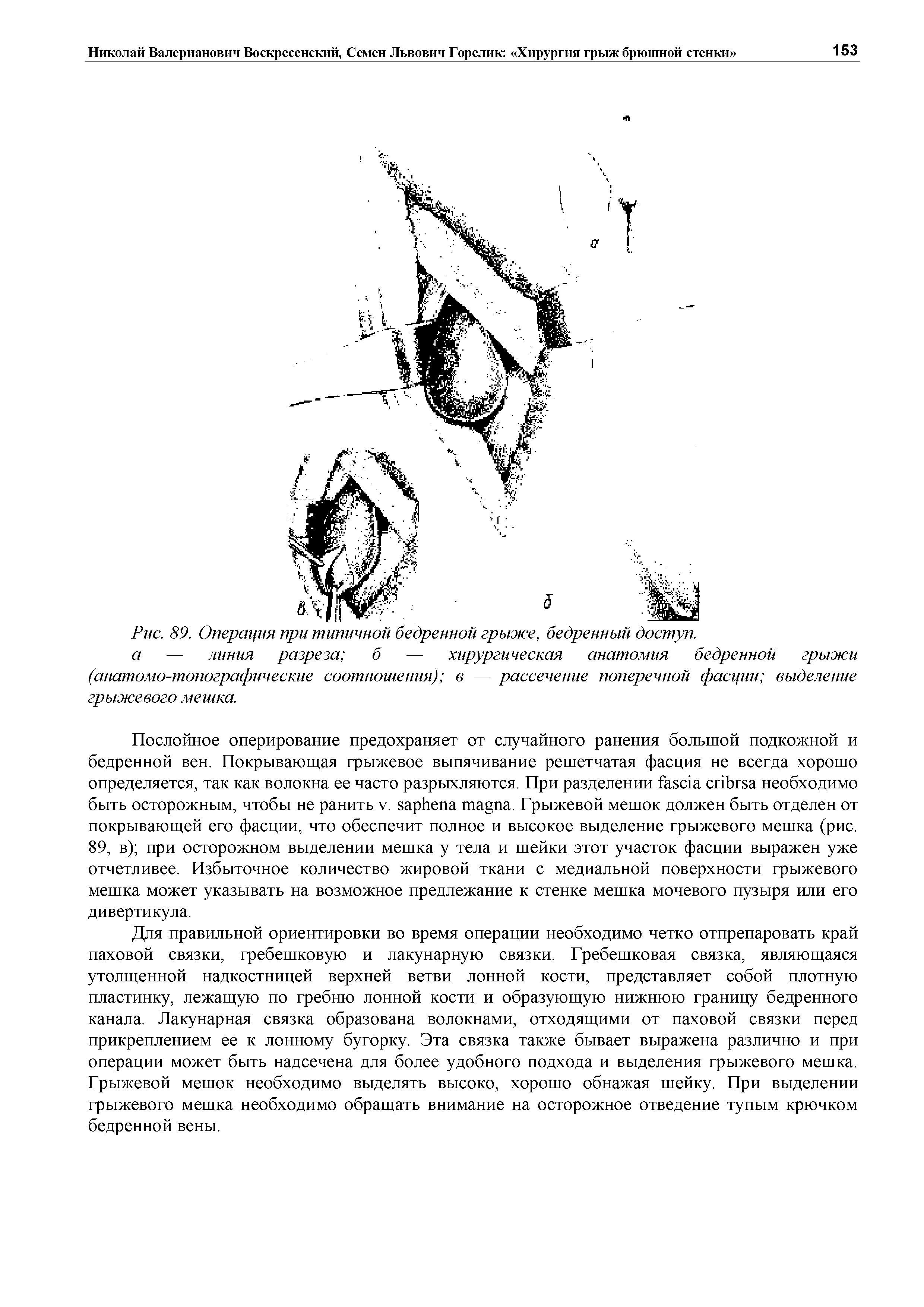 Рис. 89. Операция при типичной бедренной грыже, бедренный доступ.