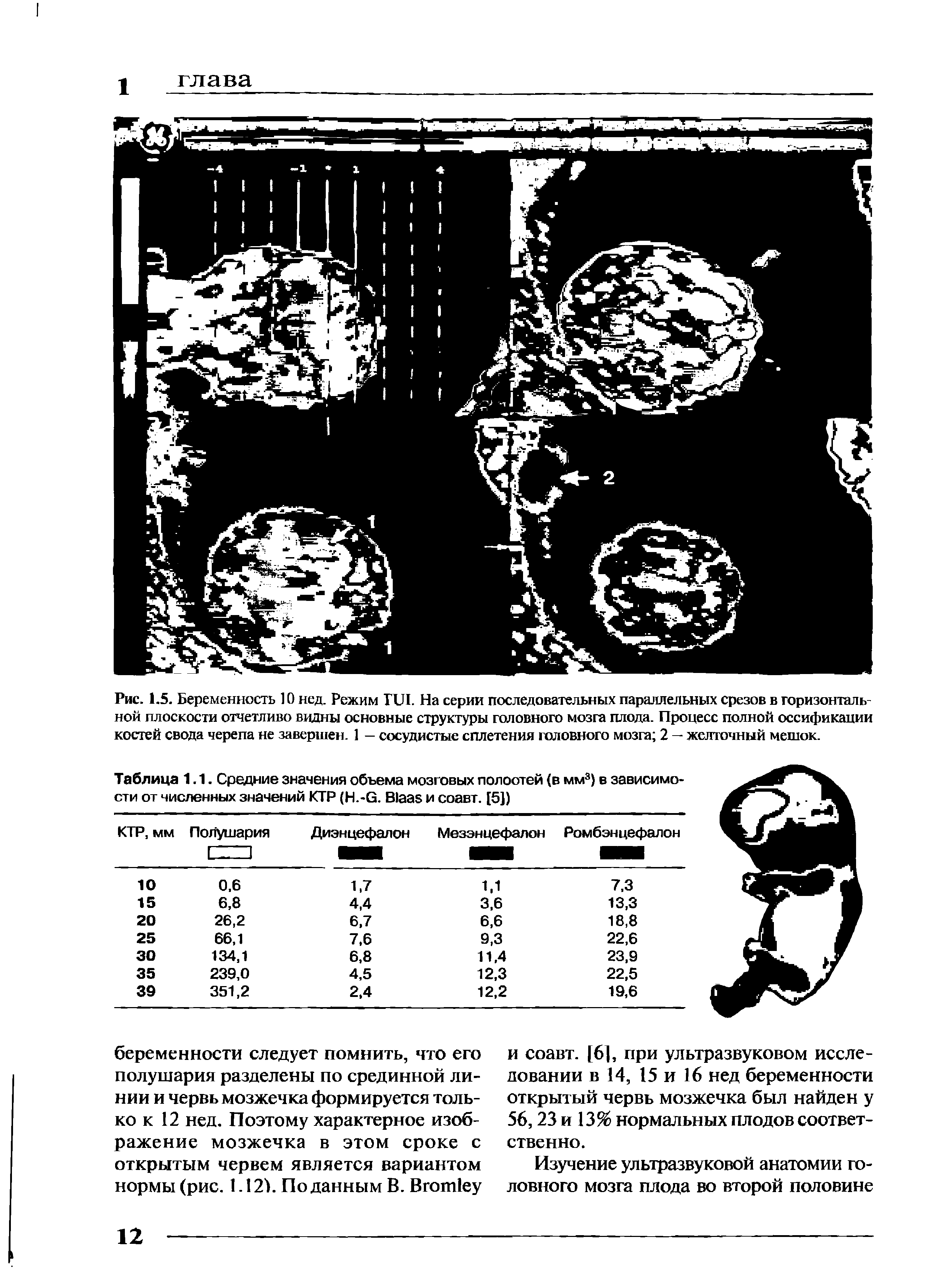 Рис. 1.5. Беременность 10 нед. Режим ПЛ. На серии последовательных параллельных срезов в горизонтальной плоскости отчетливо видны основные структуры головного мозга плода. Процесс полной оссификации костей свода черепа не завершен. 1 — сосудистые сплетения головного мозга 2 — желточный мешок.