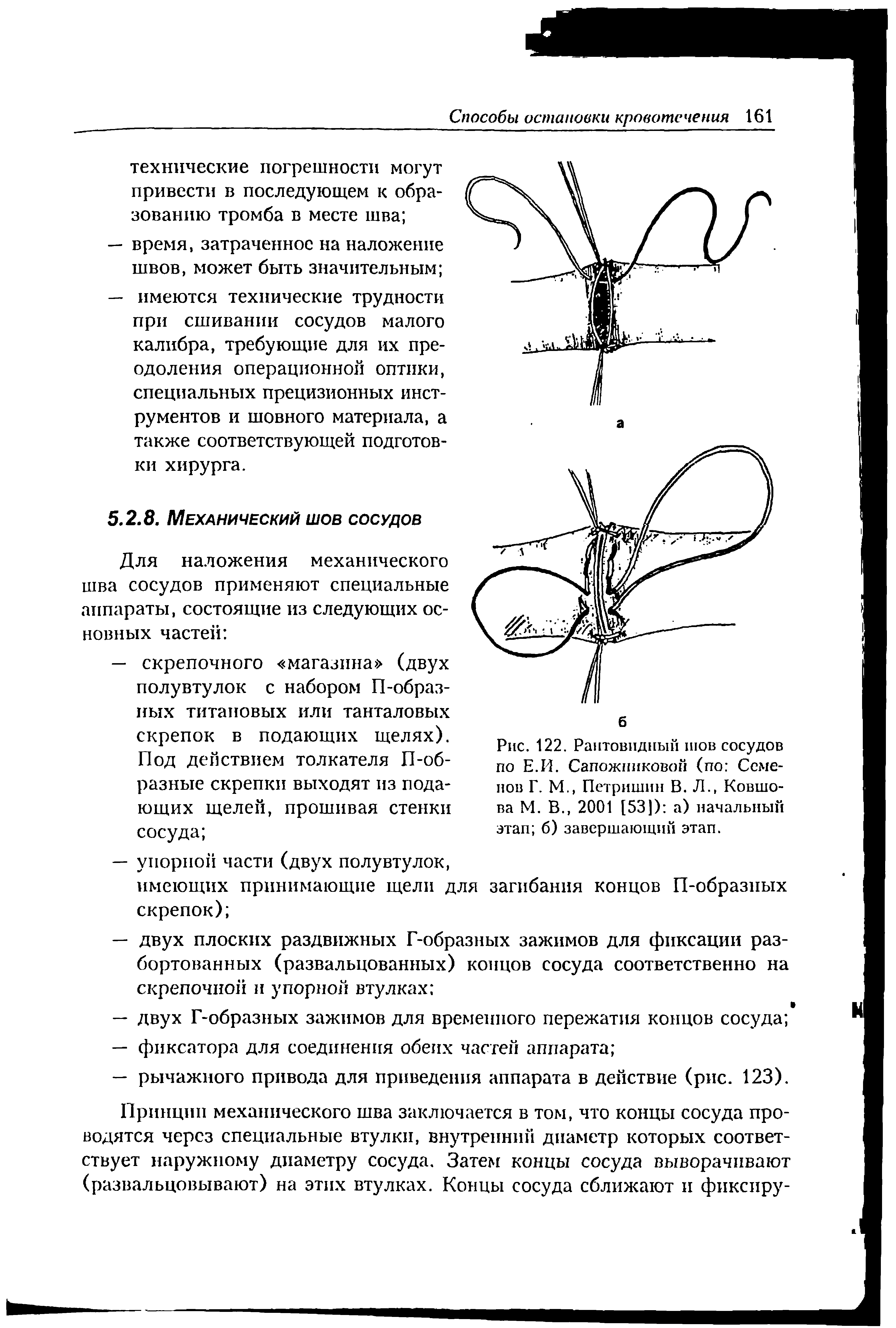 Рис. 122. Рантовидный шов сосудов по Е.И. Сапожниковой (по Семенов Г. М., Петришин В. Л., Ковшова М. В., 2001 [53]) а) начальный этап б) завершающий этап.