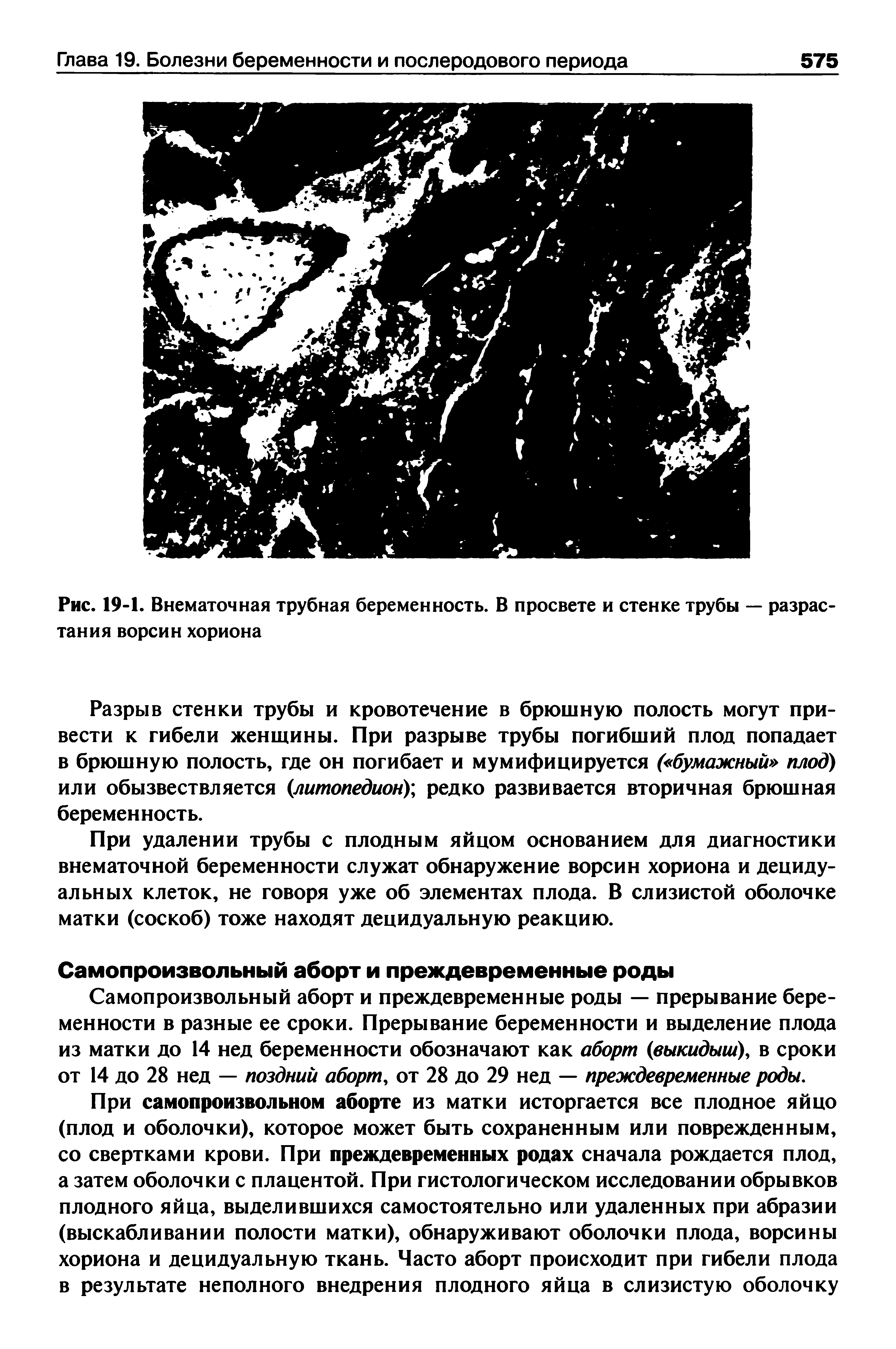 Рис. 19-1. Внематочная трубная беременность. В просвете и стенке трубы — разрастания ворсин хориона...