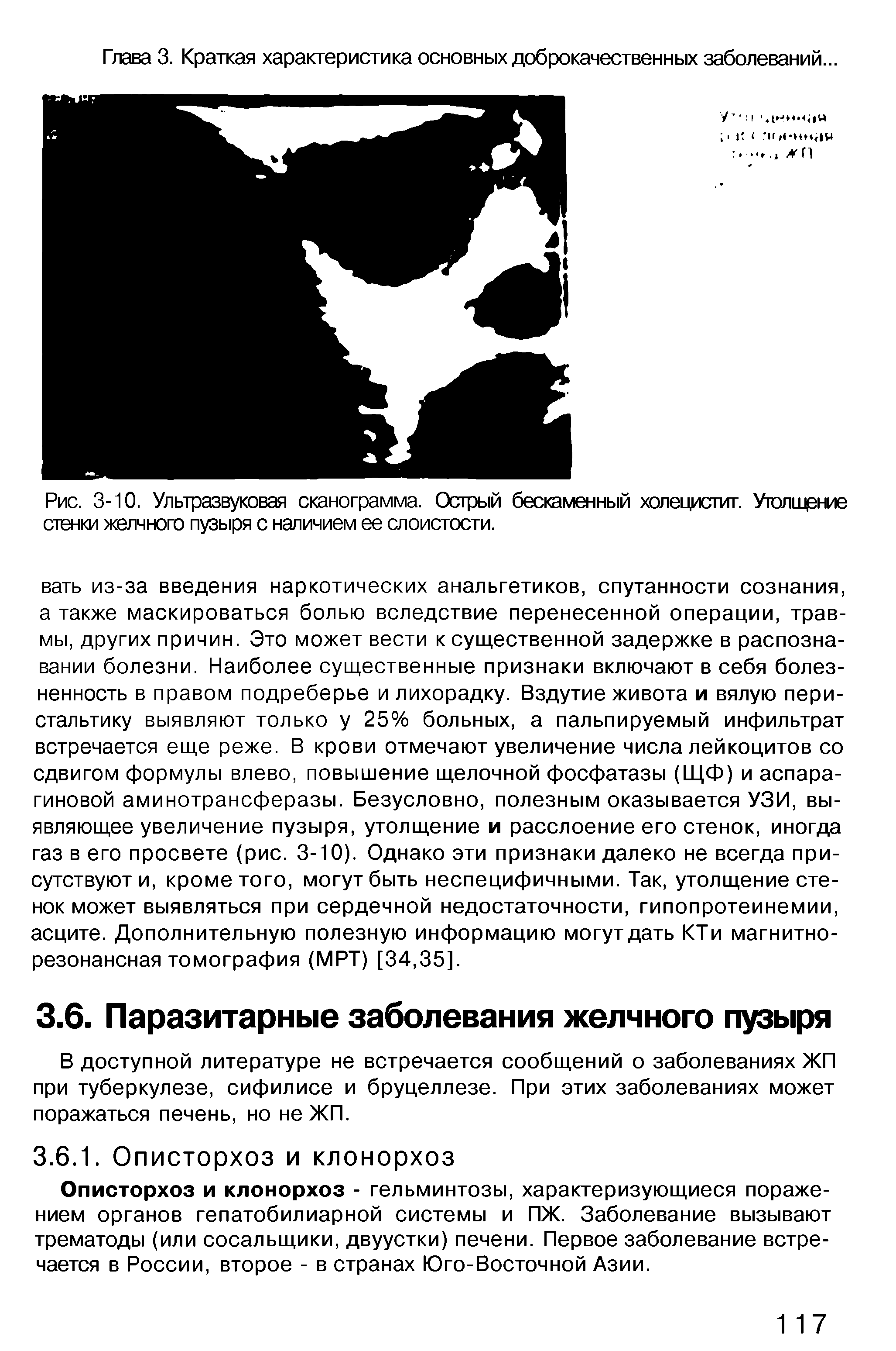 Рис. 3-10. Ультразвуковая сканограмма. Острый бескаменный холецистит. Уголшрние стенки желчного пузыря с наличием ее слоистости.