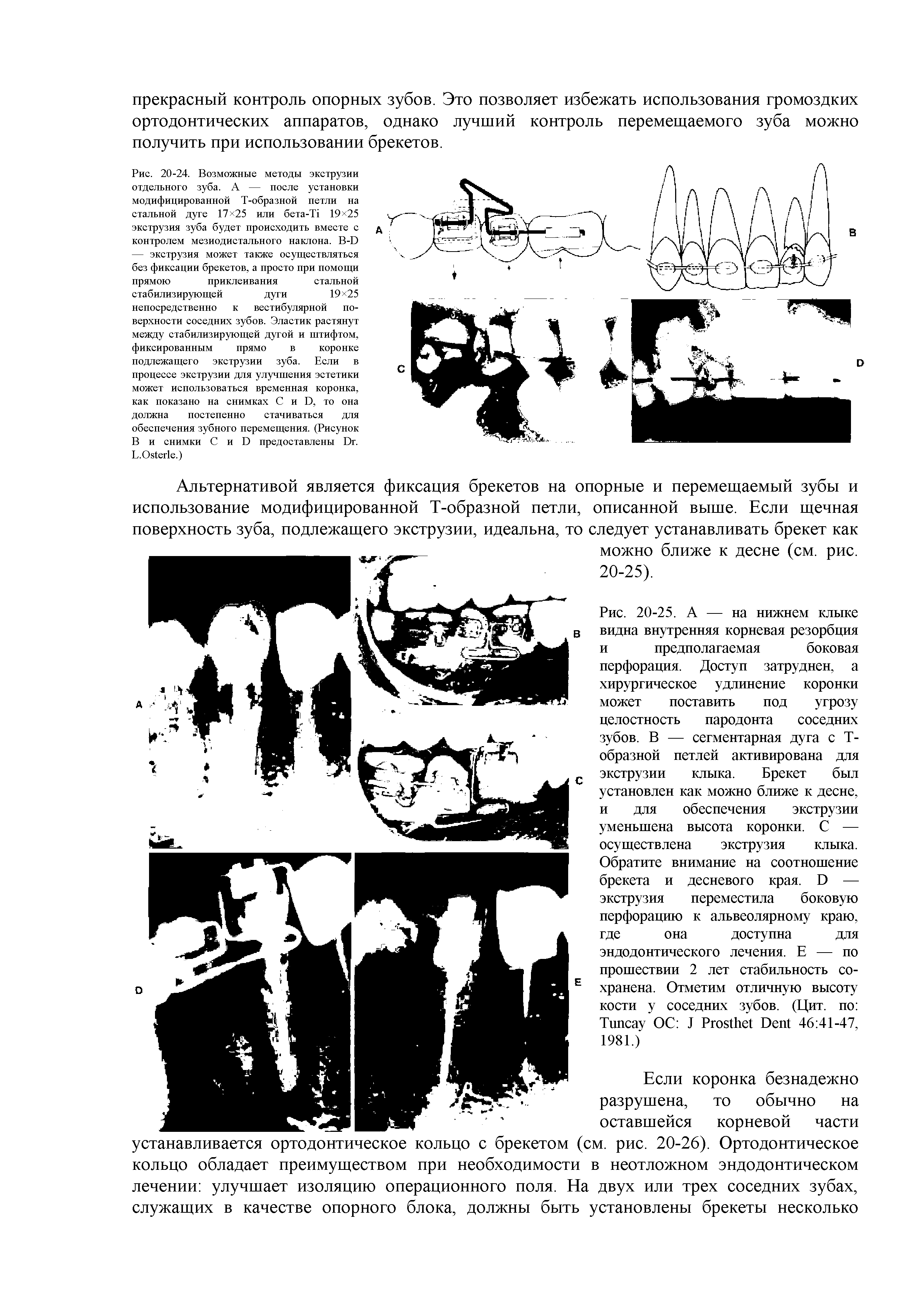 Рис. 20-24. Возможные методы экструзии отдельного зуба. А — после установки модифицированной Т-образной петли на стальной дуге 17 25 или бета-Т1 19 25 экструзия зуба будет происходить вместе с контролем мезиодистального наклона. В-0 — экструзия может также осуществляться без фиксации брекетов, а просто при помощи прямою приклеивания стальной...