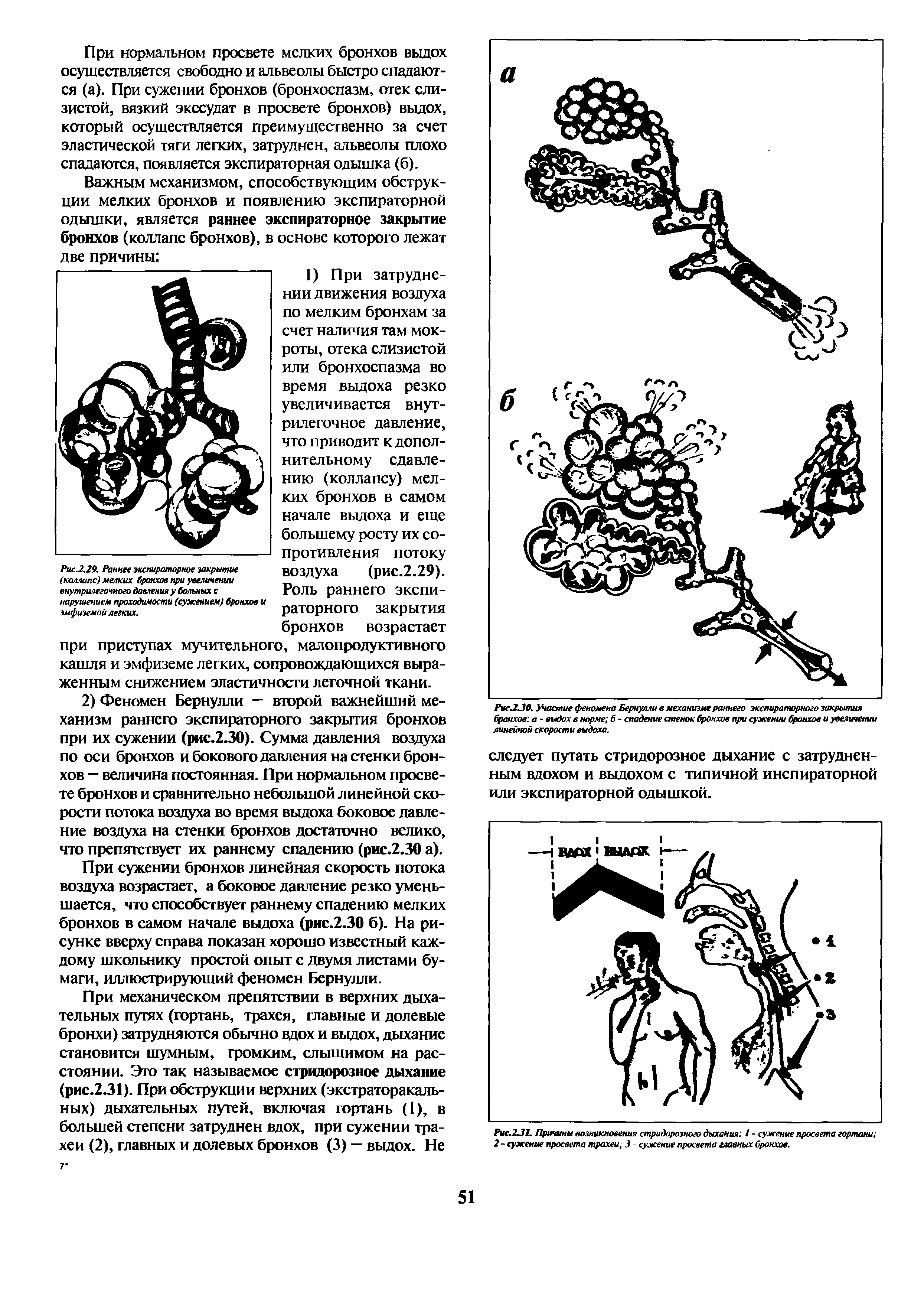 Рис.2.29. Раннее экспираторное закрытие (коллапс) мелких бронхов при увеличении внутрилегочного давления у больных с нарушением проходимости (сужением) бронхов и эмфиземой легких.