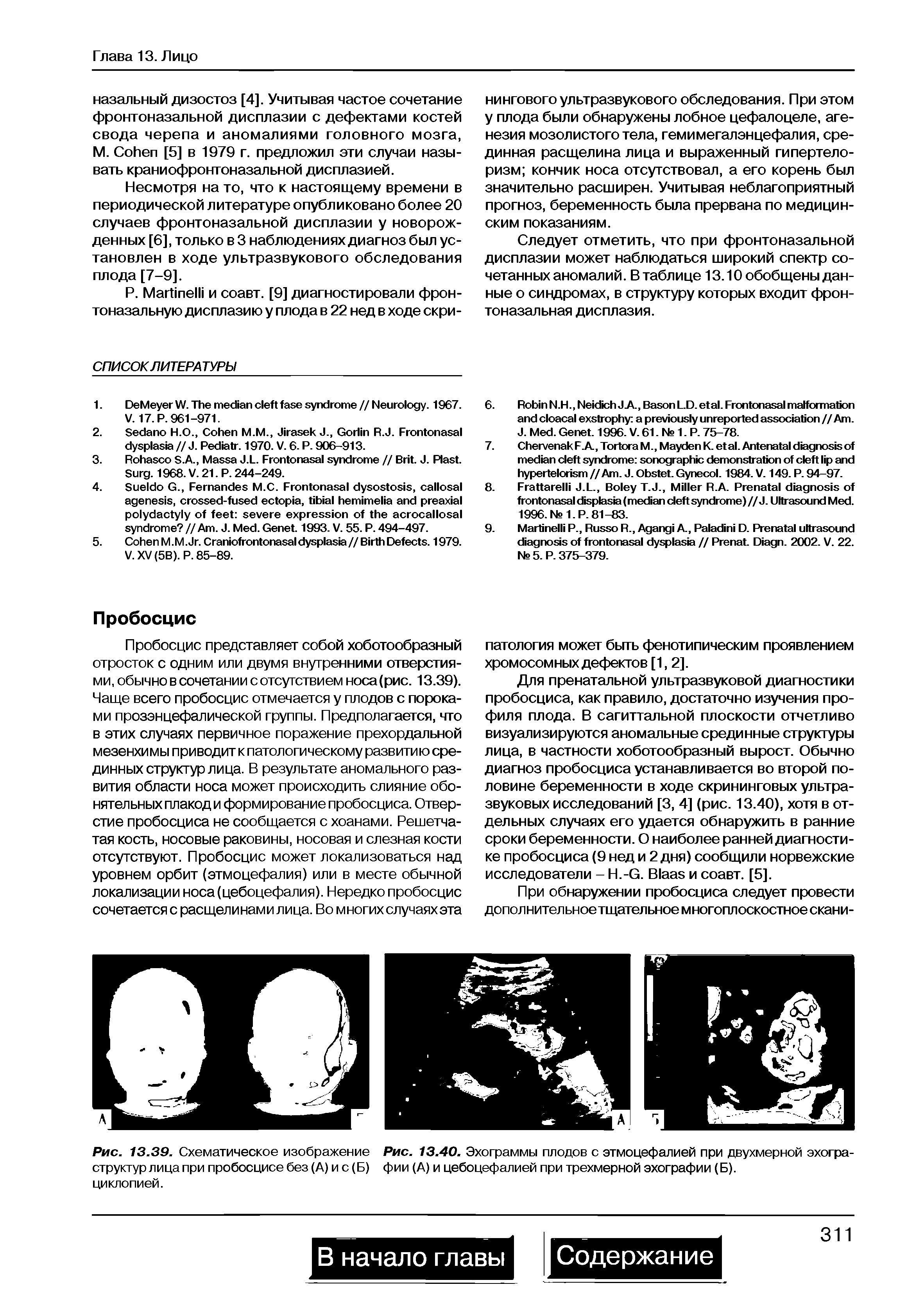 Рис. 13.39. Схематическое изображение Рис. 13.40. Эхограммы плодов с этмоцефалией при двухмерной эхогра-структур лица при пробосцисе без (А) и с (Б) фии (А) и цебоцефалией при трехмерной эхографии (Б), циклопией.