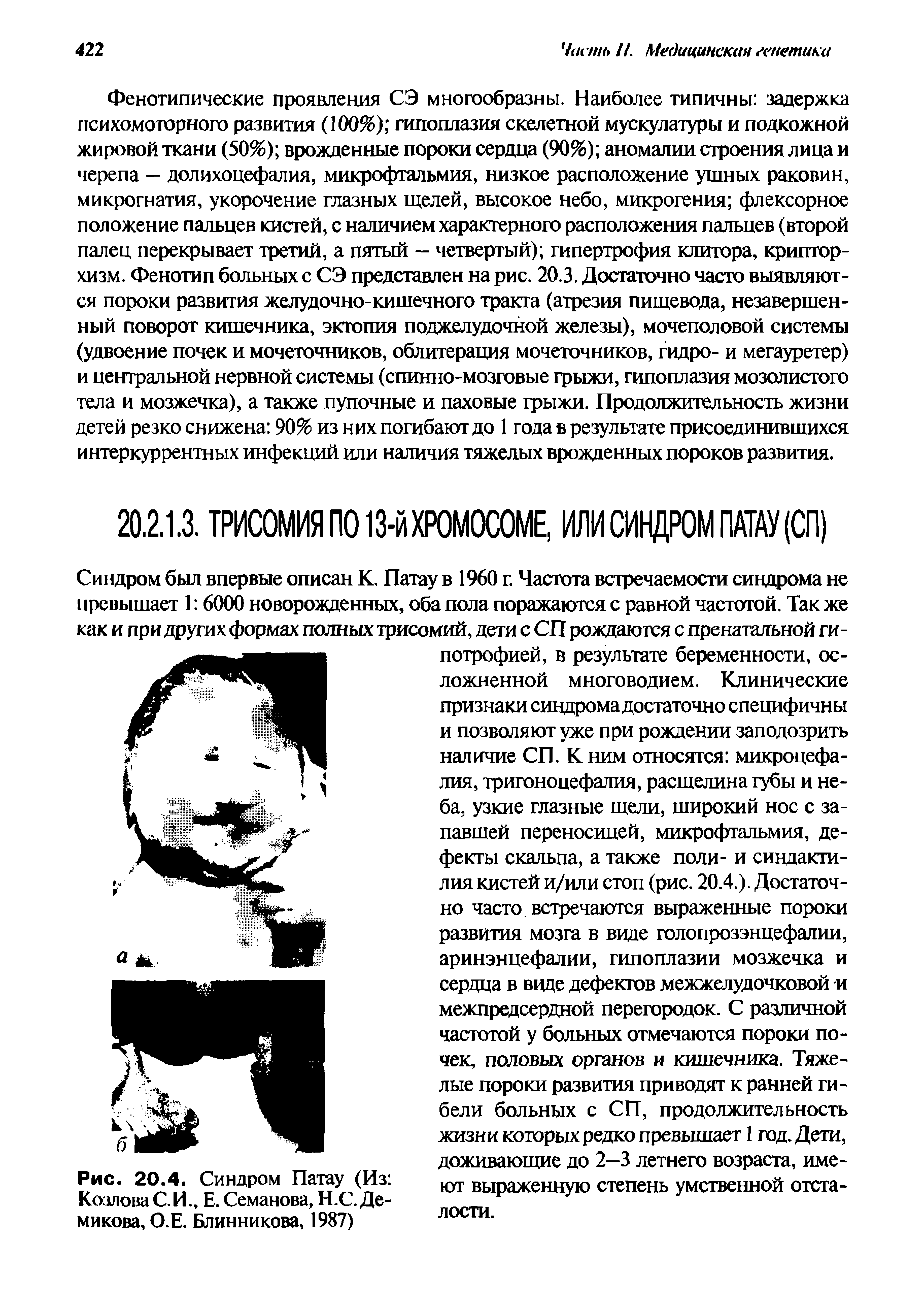 Рис. 20.4. Синдром Патау (Из Козлова С. И., Е. Семанова, Н.С. Де-микова, О.Е. Блинникова, 1987)...