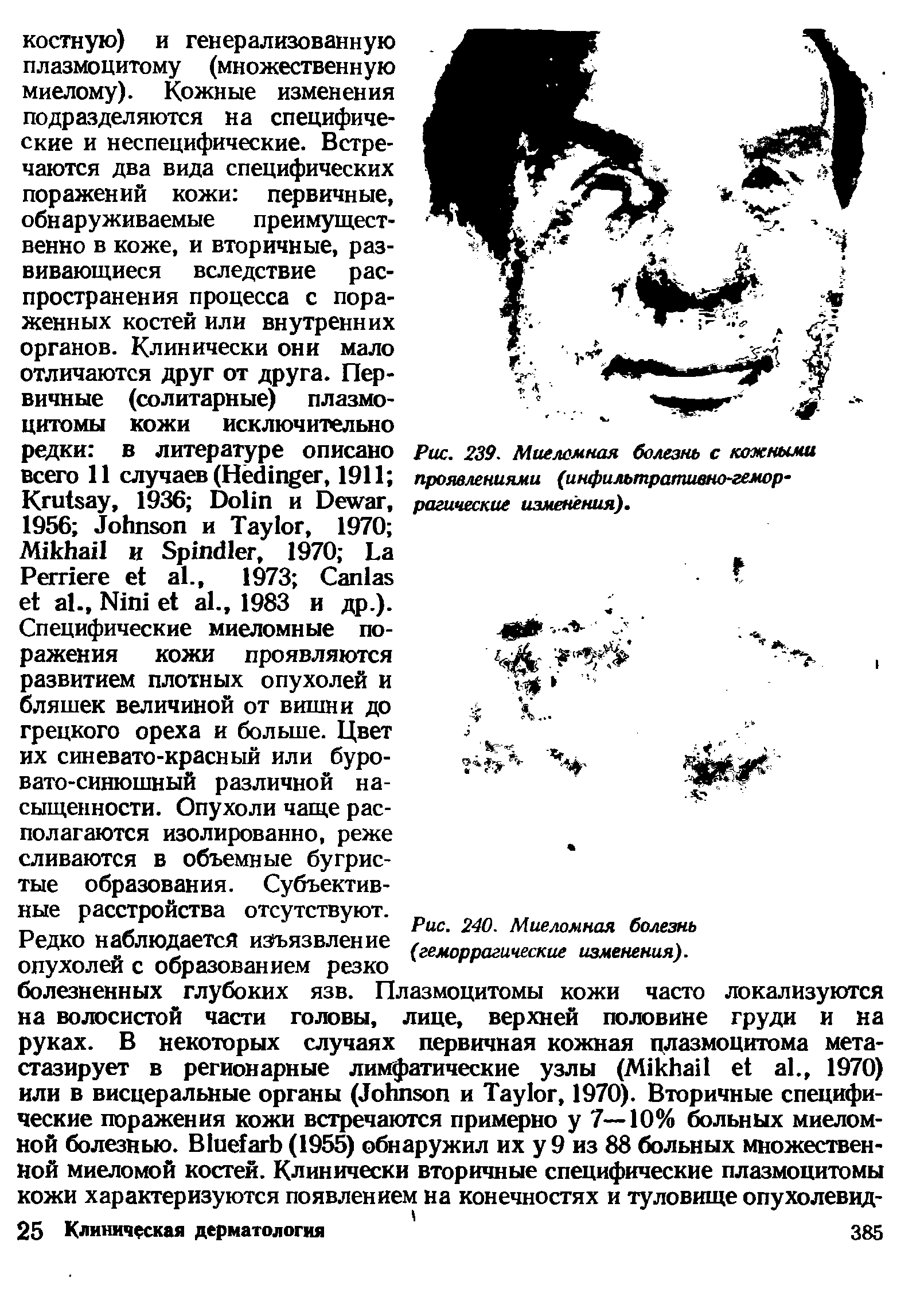 Рис. 239. Миеломная болезнь с кожными проявлениями (инфильтративно-геморрагические изменения).