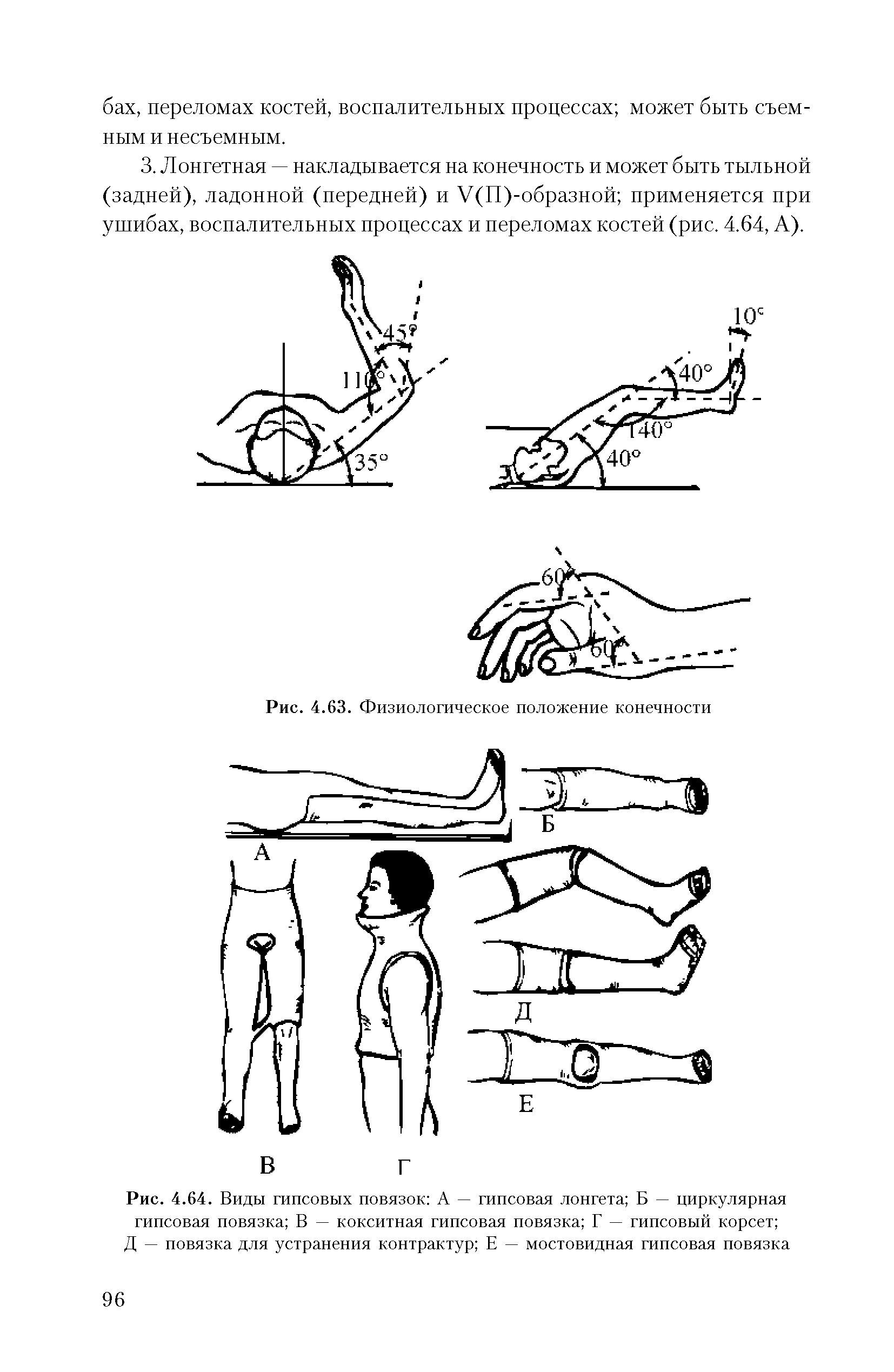 Рис. 4.64. Виды гипсовых повязок А — гипсовая лонгета Б — циркулярная гипсовая повязка В — кокситная гипсовая повязка Г — гипсовый корсет ...