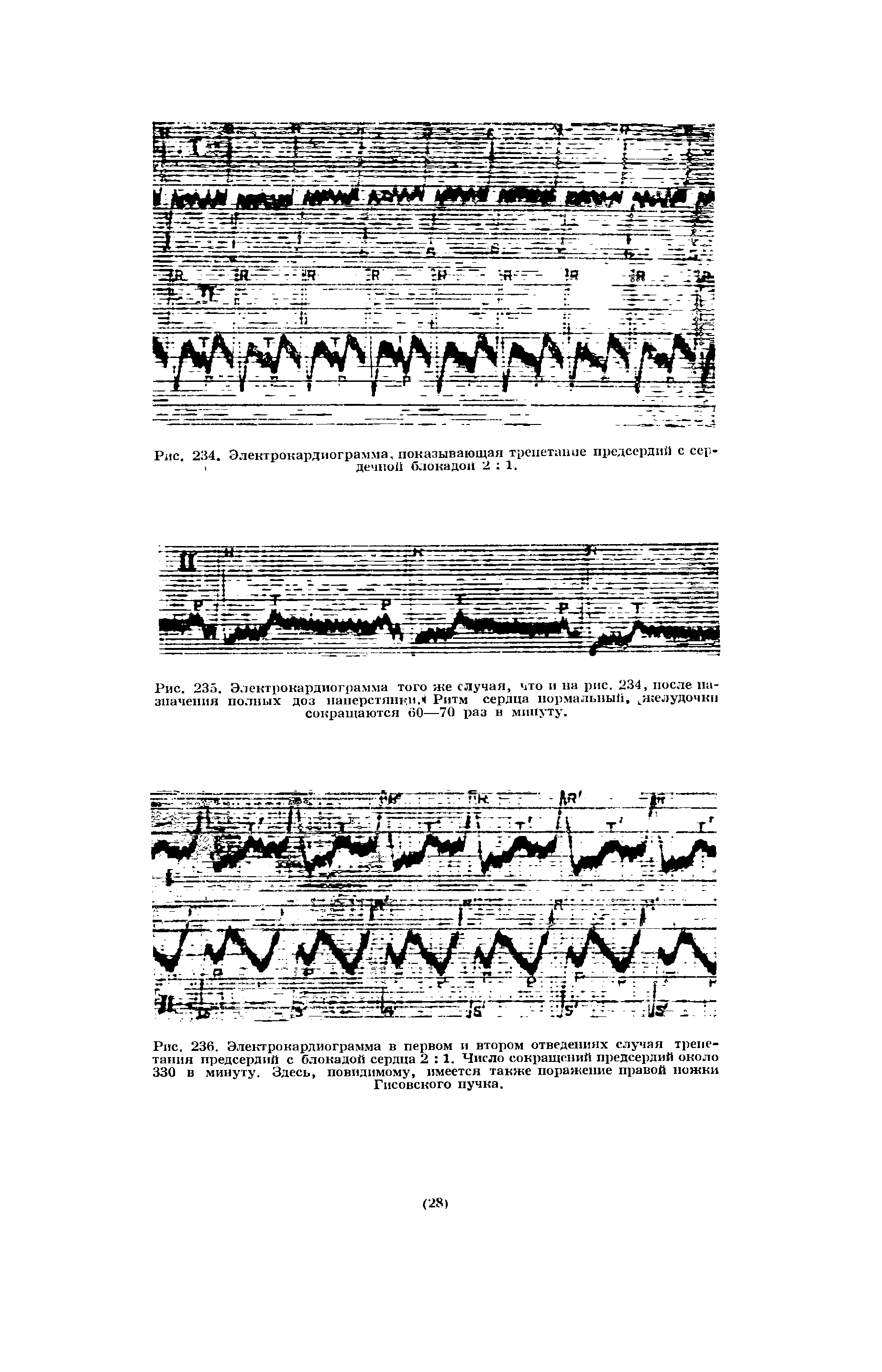 Рис. 236. Электрокардиограмма в первом и втором отведениях случая трепетания предсердий с блокадой сердца 2 1. Число сокращений предсердий около 330 в минуту. Здесь, повидимому, имеется также поражение правой ножки Гисовского пучка.