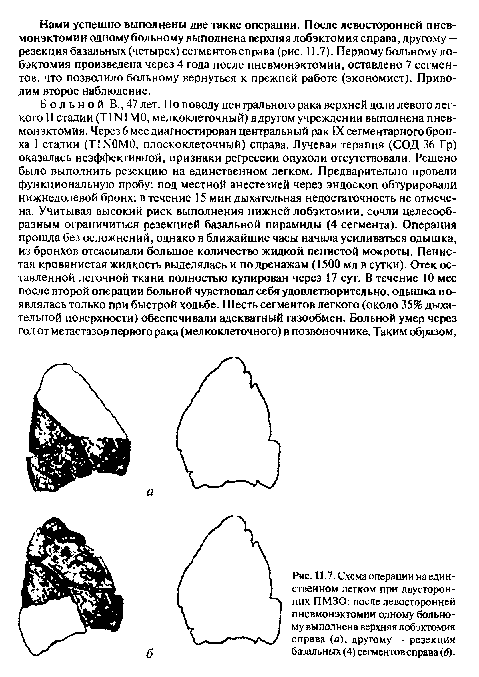 Рис. 11.7. Схема операции на единственном легком при двусторонних ПМЗО после левосторонней пневмонэктомии одному больному выполнена верхняя лобэктомия справа (о), другому — резекция базальных (4) сегментов справа (б).