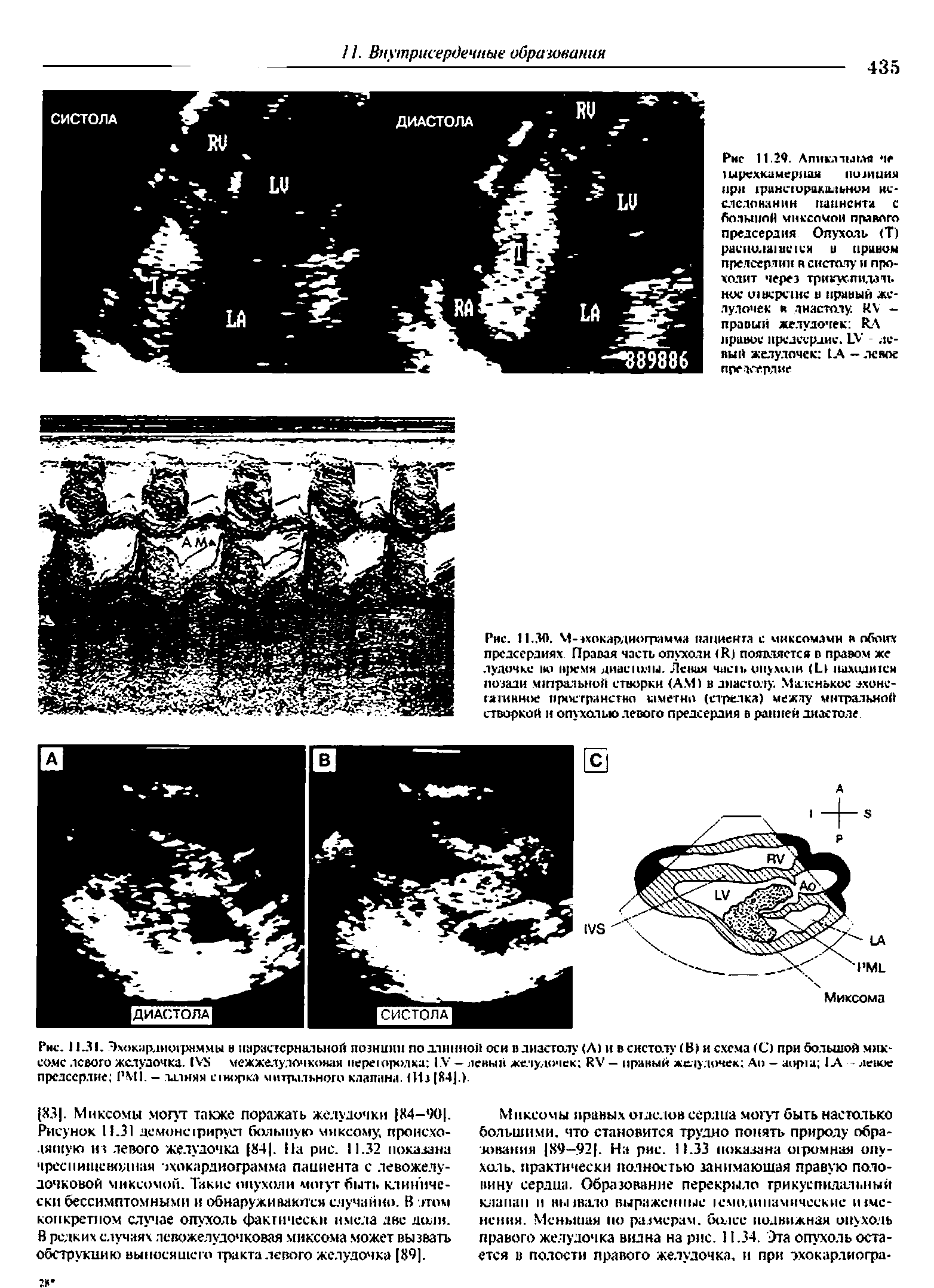 Рис. 11.31. Эх<жар.1ми1рн.ммы в парастернальной позиции подлинной оси в диастолу (Л) и в систолу (В) и схема (С) при большой миксоме левого желудочка. IV межжелудочковая переюролха IV — левый желудочек RV — правый желудочек До - IА - ясное предсердие РМ1. — талиям икорка митрального клапана. Из 84].).