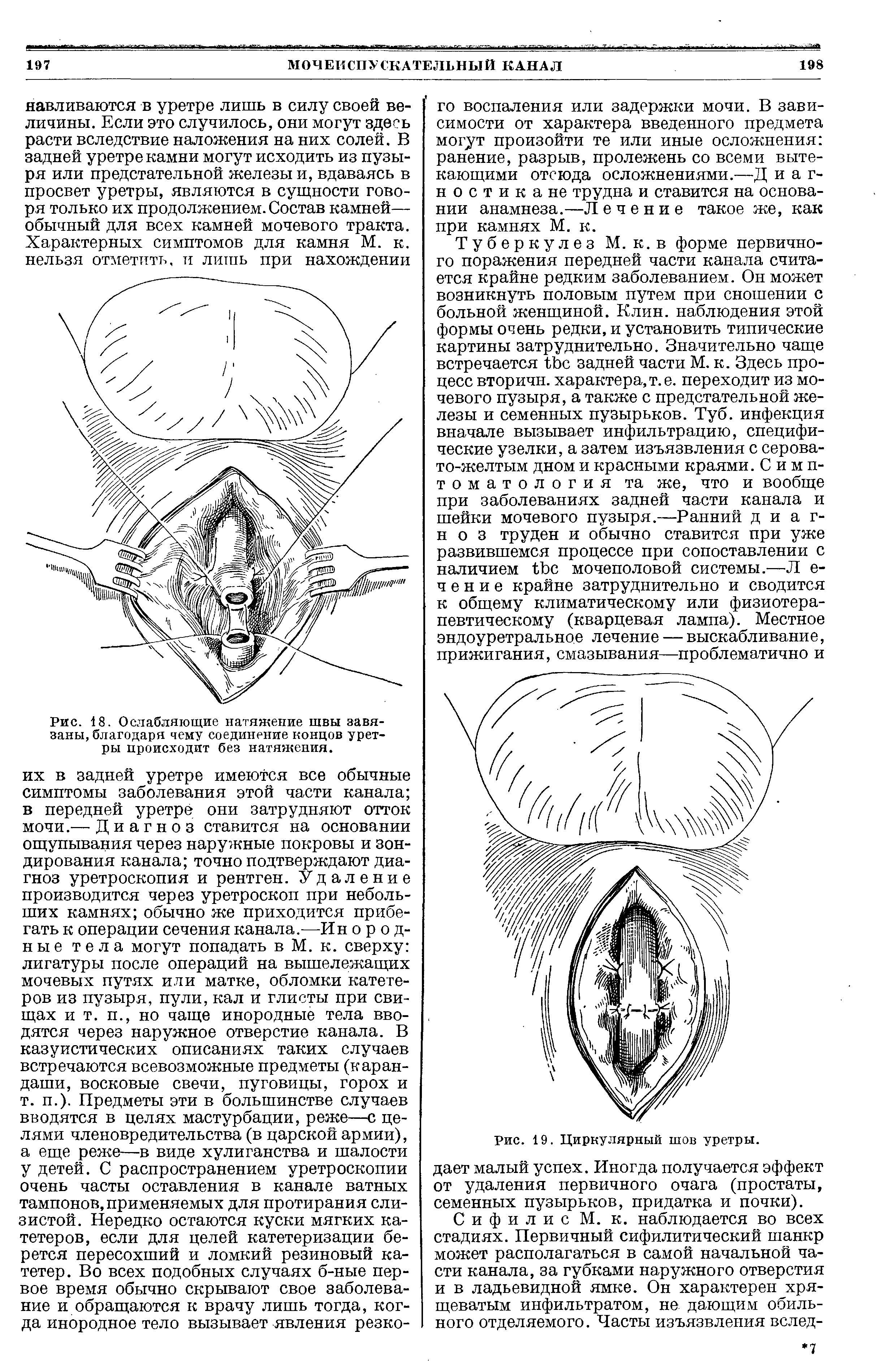 Рис. 19. Циркулярный шов уретры, дает малый успех. Иногда получается эффект от удаления первичного очага (простаты, семенных пузырьков, придатка и почки).