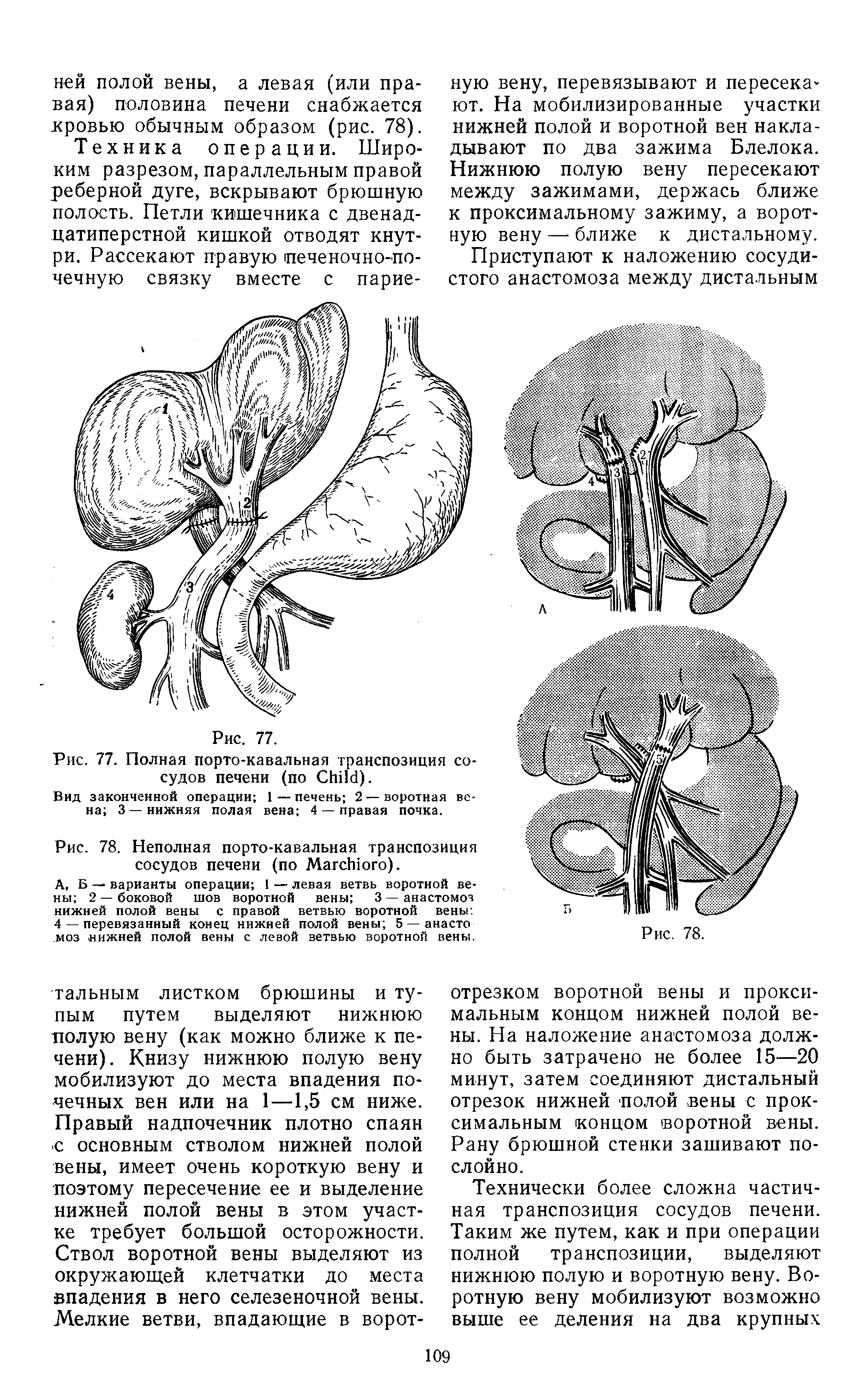 Рис. 77. Полная порто-кавальная транспозиция сосудов печени (по C ).