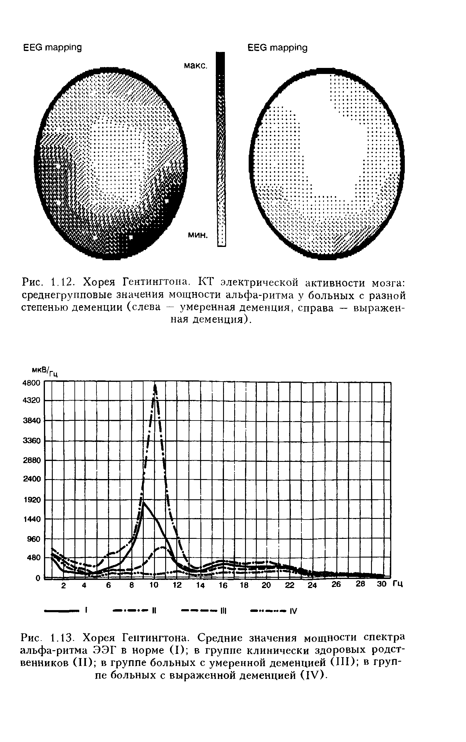 Рис. 1.13- Хорея Гентингтона. Средние значения мощности спектра альфа-ритма ЭЭГ в норме (I) в группе клинически здоровых родственников (II) в группе больных с умеренной деменцией (III) в группе больных с выраженной деменцией (IV).