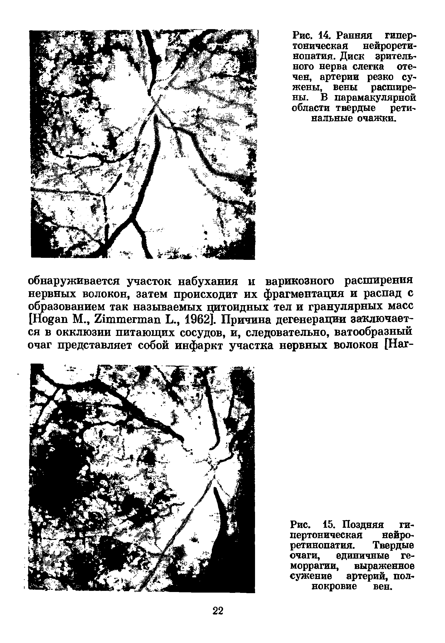 Рис. 15. Поздняя гипертоническая нейроретинопатия. Твердые очаги, единичные геморрагии, выраженное сужение артерий, полнокровие вен.