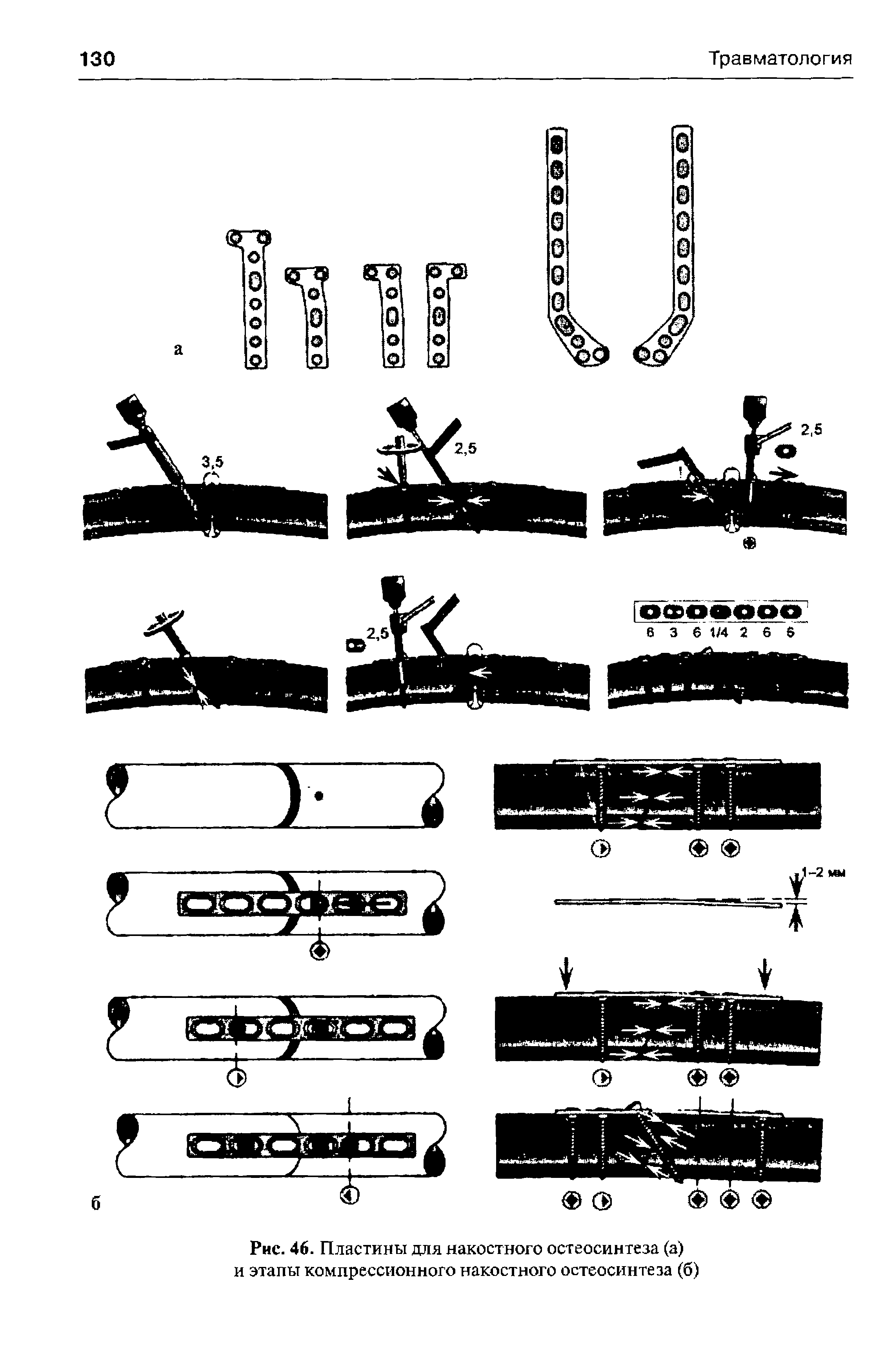 Рис. 46. Пластины для накостного остеосинтеза (а) и этапы компрессионного накостного остеосинтеза (б)...