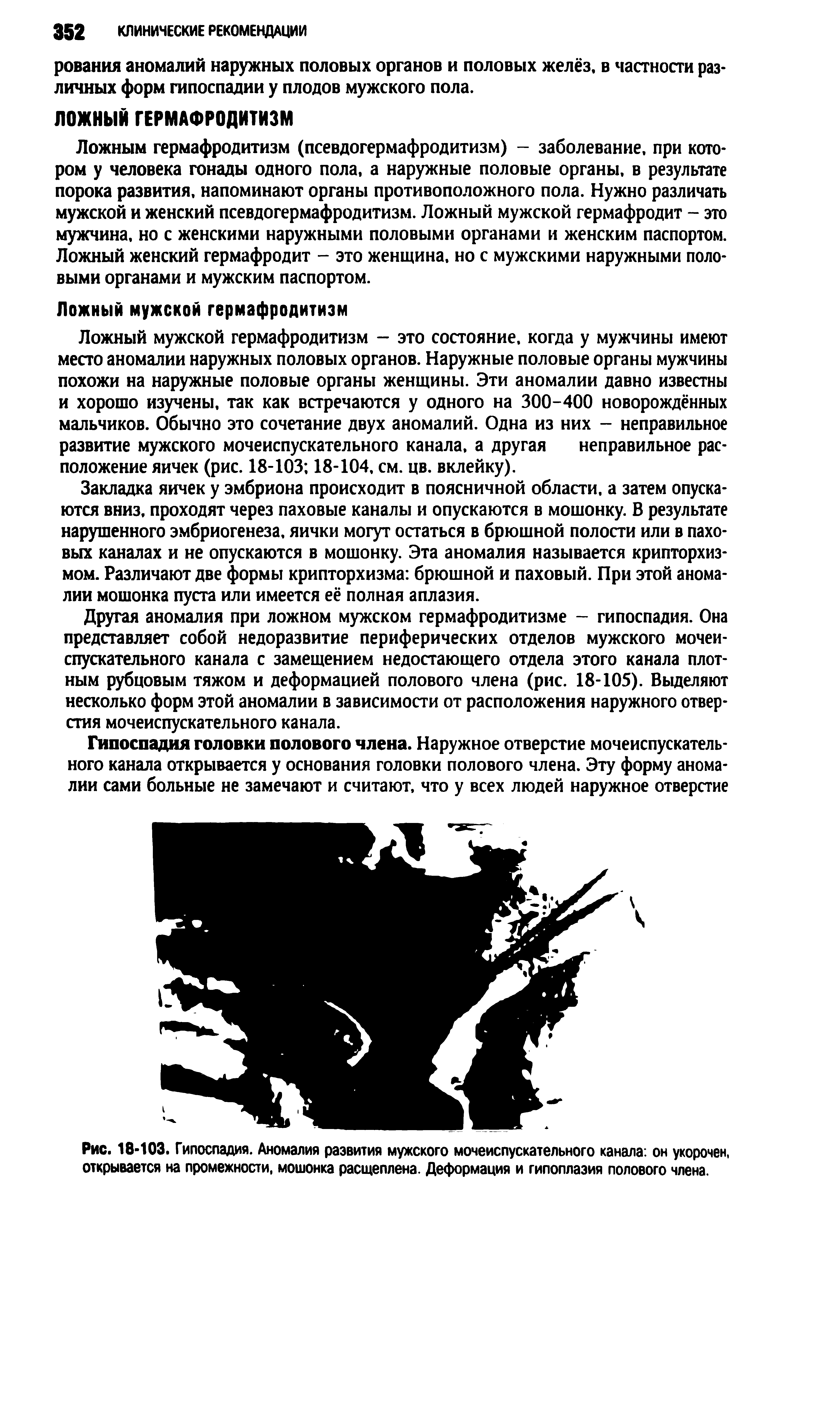 Рис. 18-103. Гипоспадия. Аномалия развития мужского мочеиспускательного канала, он укорочен, открывается на промежности, мошонка расщеплена. Деформация и гипоплазия полового члена.