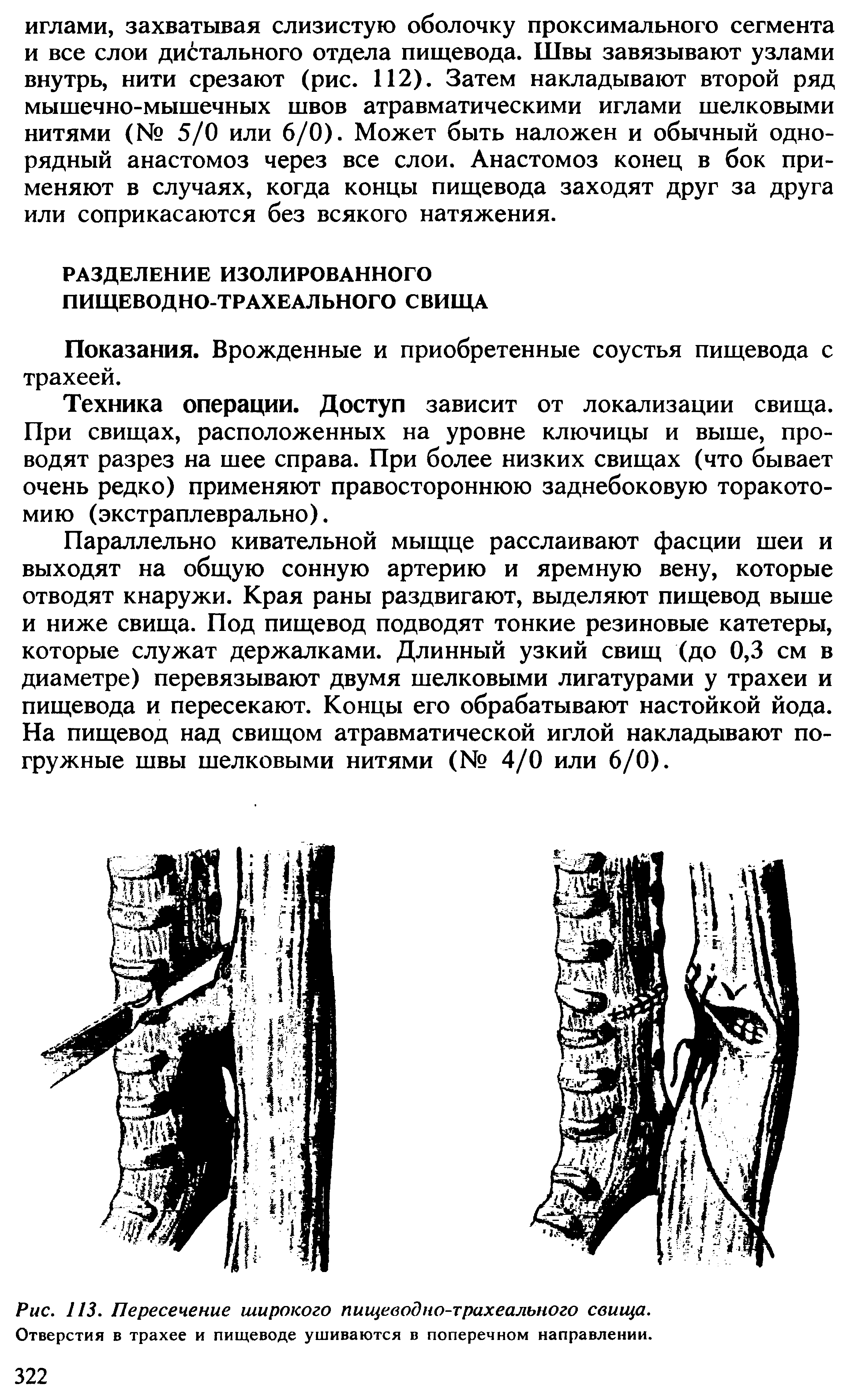 Рис. 113. Пересечение широкого пищеводно-трахеального свища. Отверстия в трахее и пищеводе ушиваются в поперечном направлении.