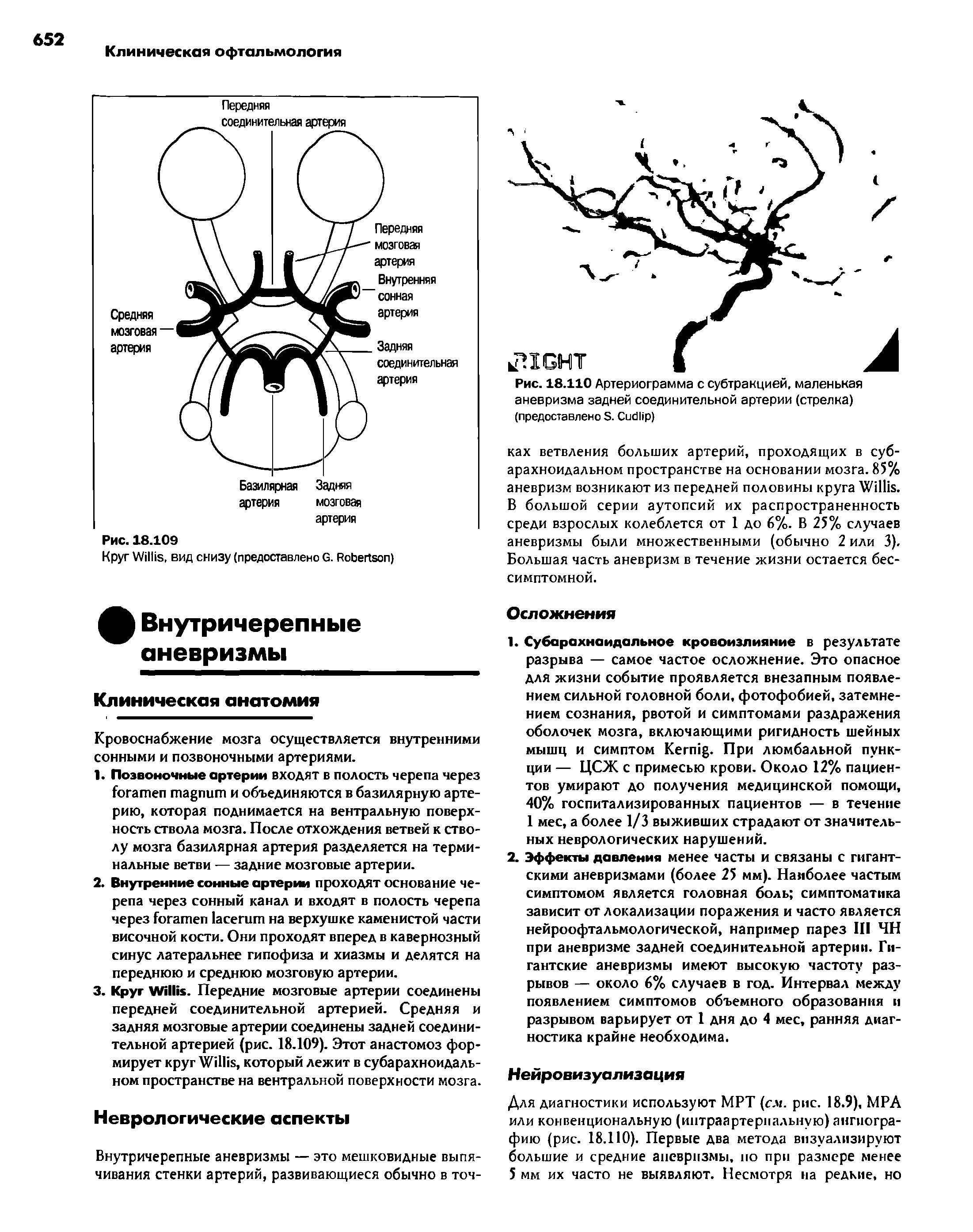 Рис. 18.110 Артериограмма с субтракцией, маленькая аневризма задней соединительной артерии (стрелка)...